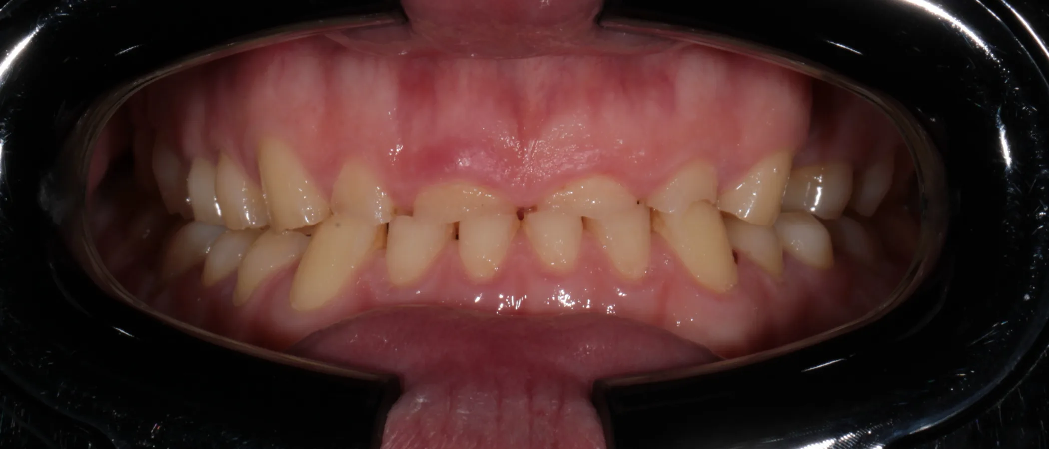 Severe bruxism case before and after treatment – Dr Cristian Dunker, ArtSmiles Gold Coast