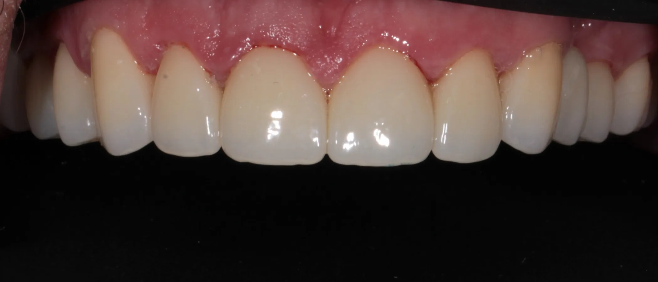 Final result of oral rehabilitation for bruxism patient – ArtSmiles Gold Coast