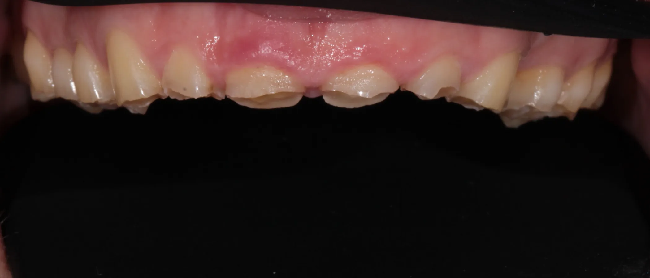 Teeth restored after severe grinding damage – ArtSmiles