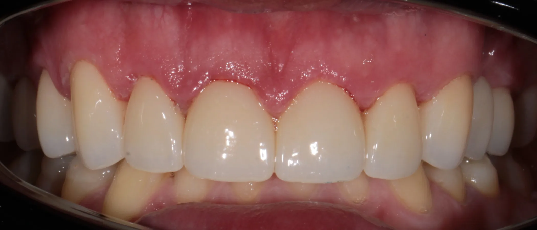 Bruxism rehabilitation with zirconia veneers – close-up view