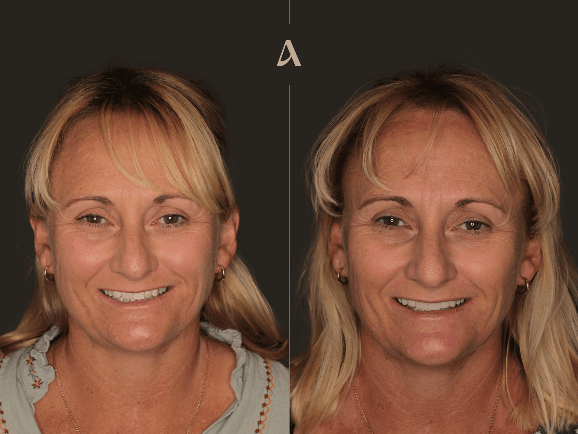 Porcelain Veneers – 1 month – ArtSmiles Gold Coast