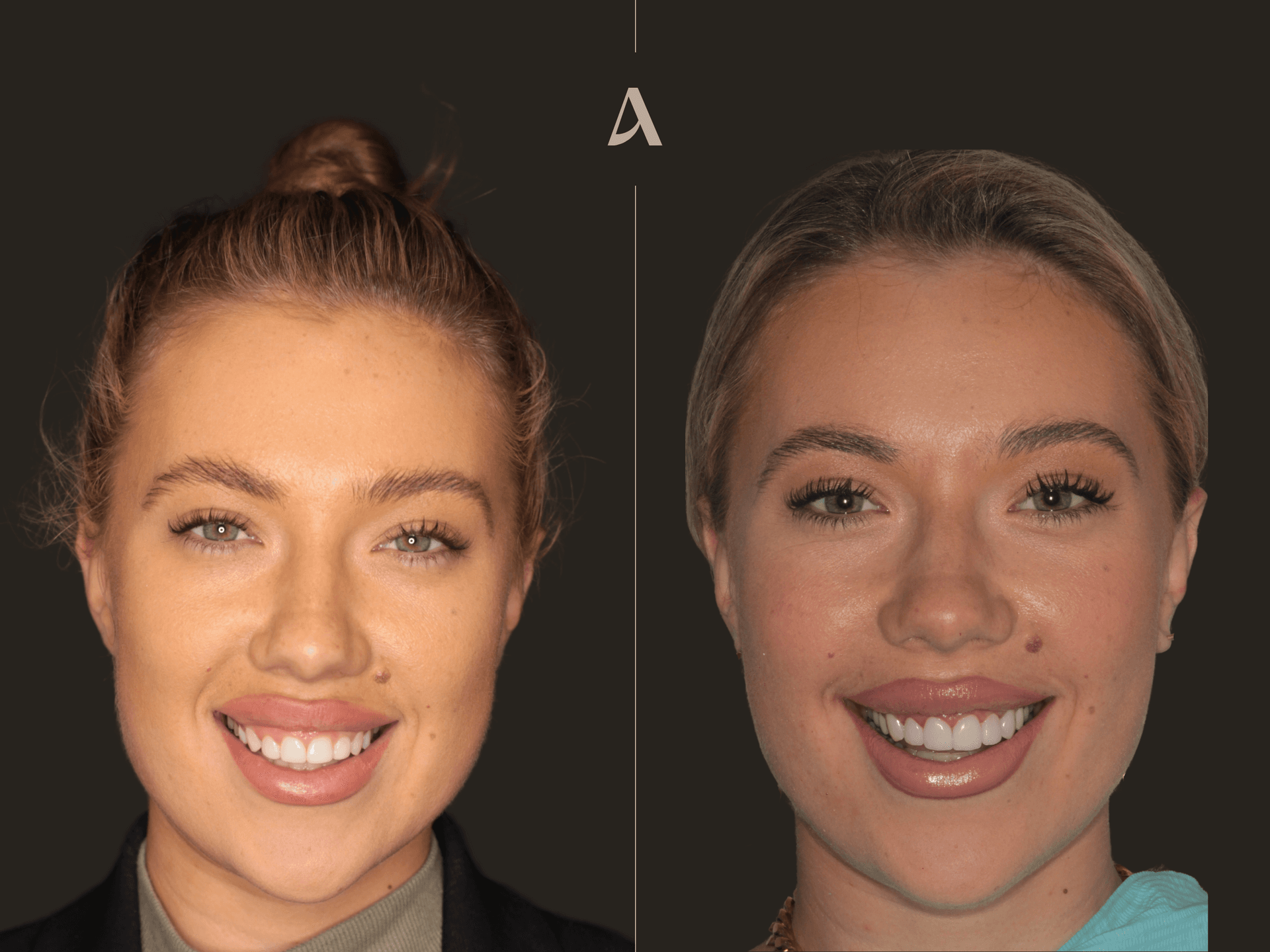 Gum Recontouring, Porcelain Veneers – 3 months – ArtSmiles Gold Coast