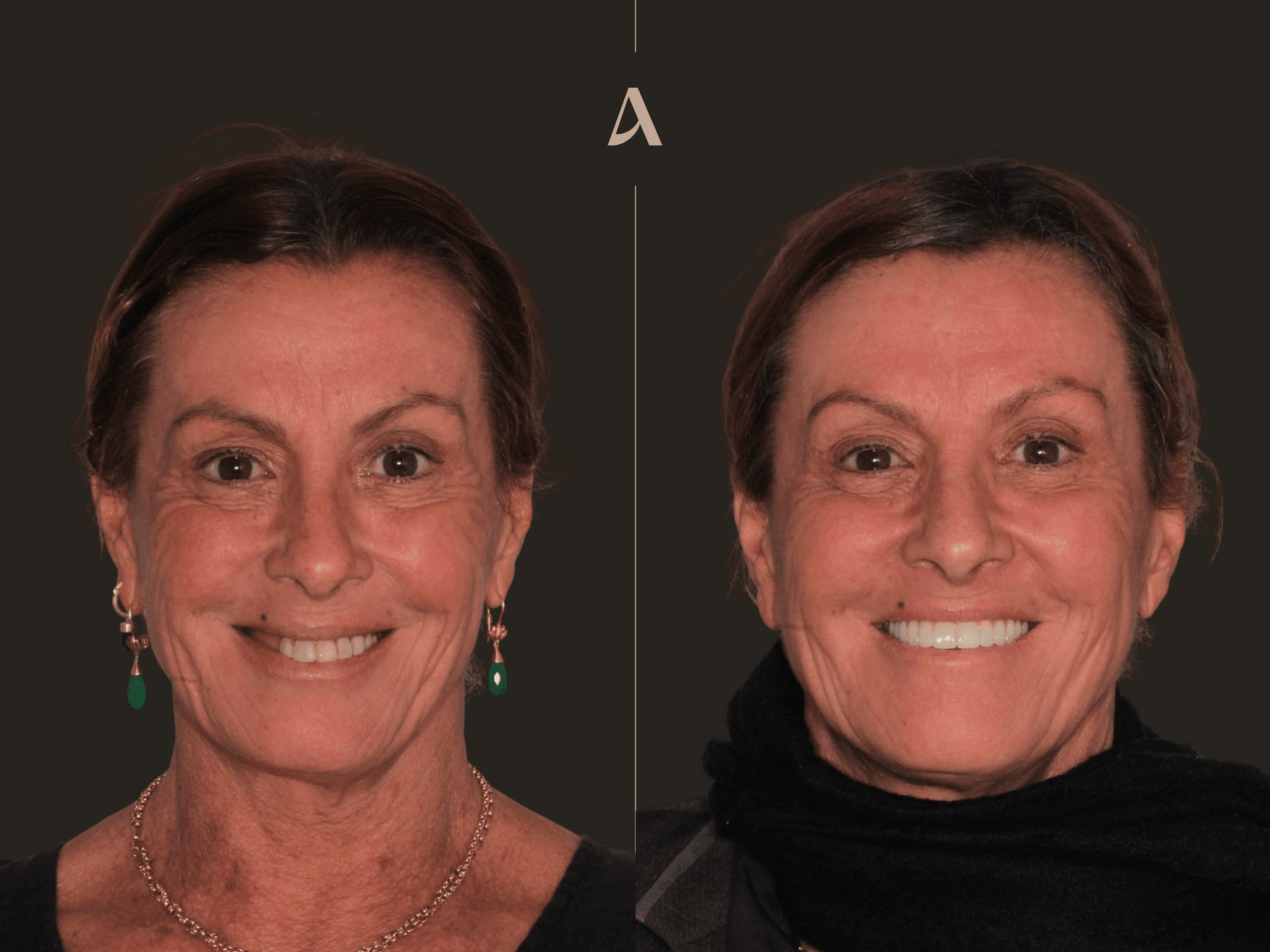 All on X – 2 months – ArtSmiles Gold Coast