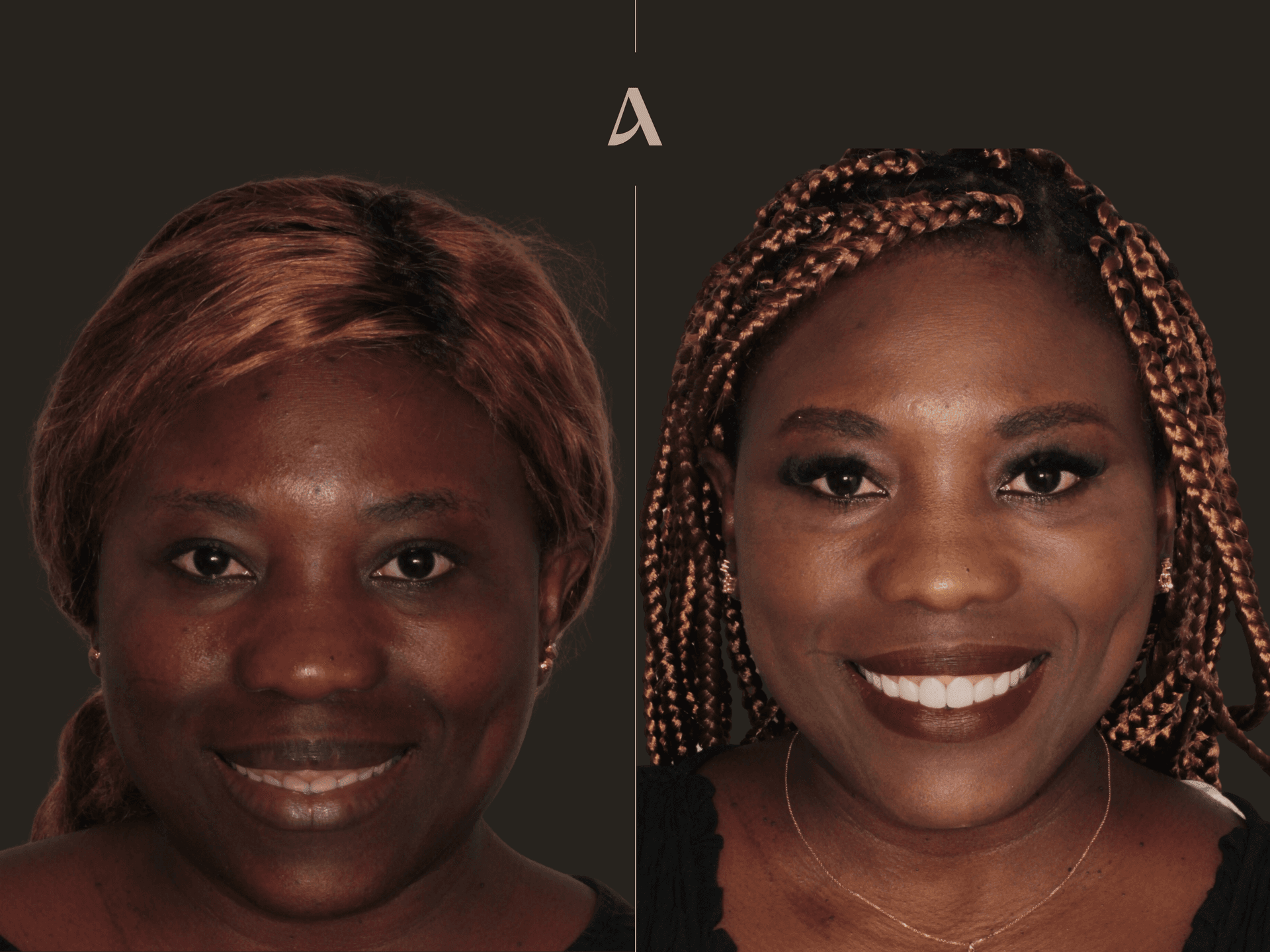 Gum Recontouring, Porcelain Veneers
