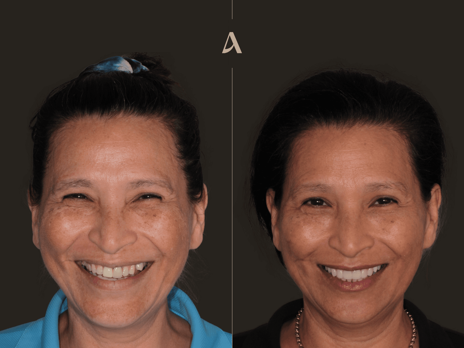 Implant & Porcelain Veneers — Before & After