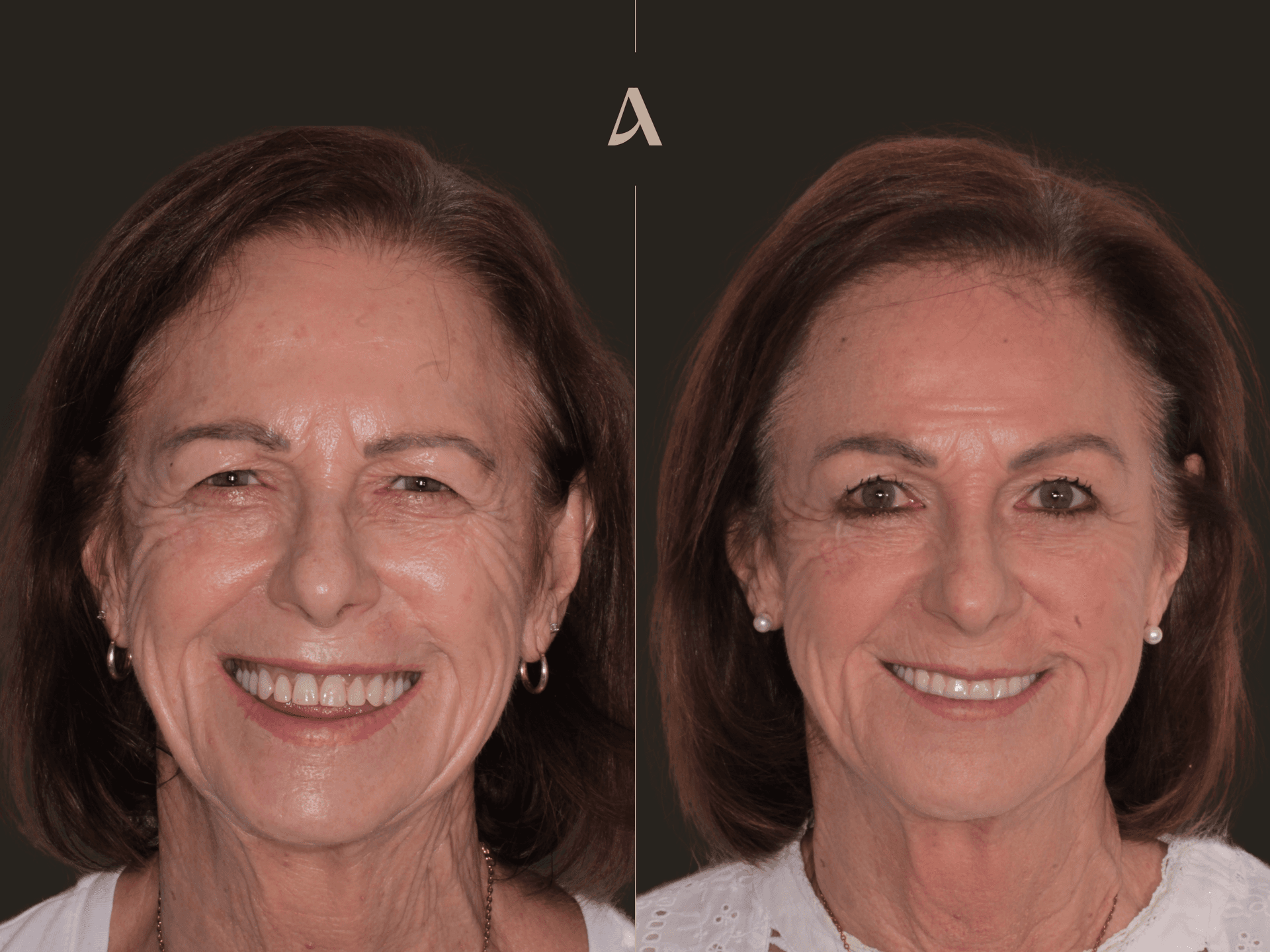 All on X — Before & After