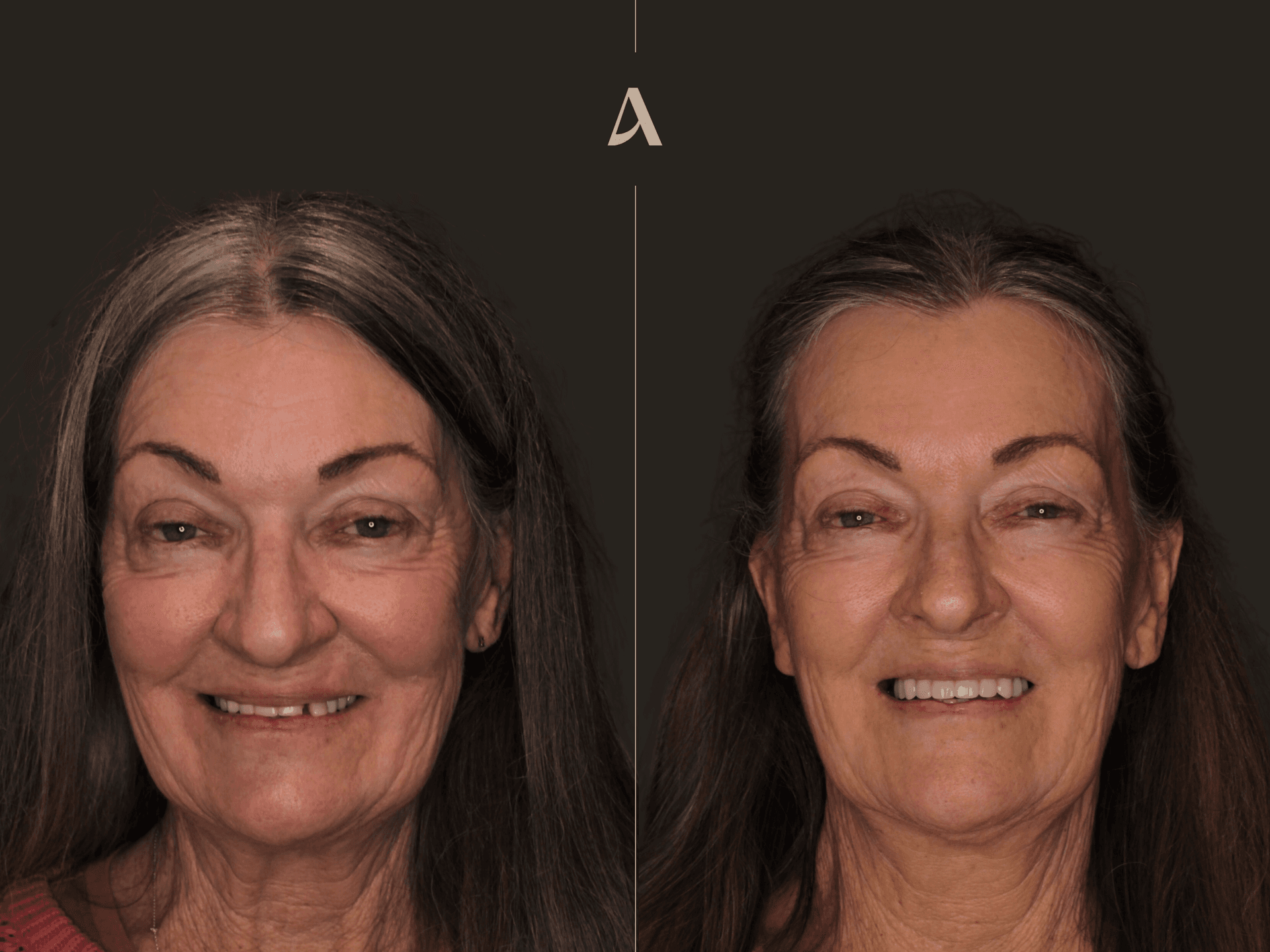 Increase Vertical Dimension, All on X – 3 months – ArtSmiles Gold Coast