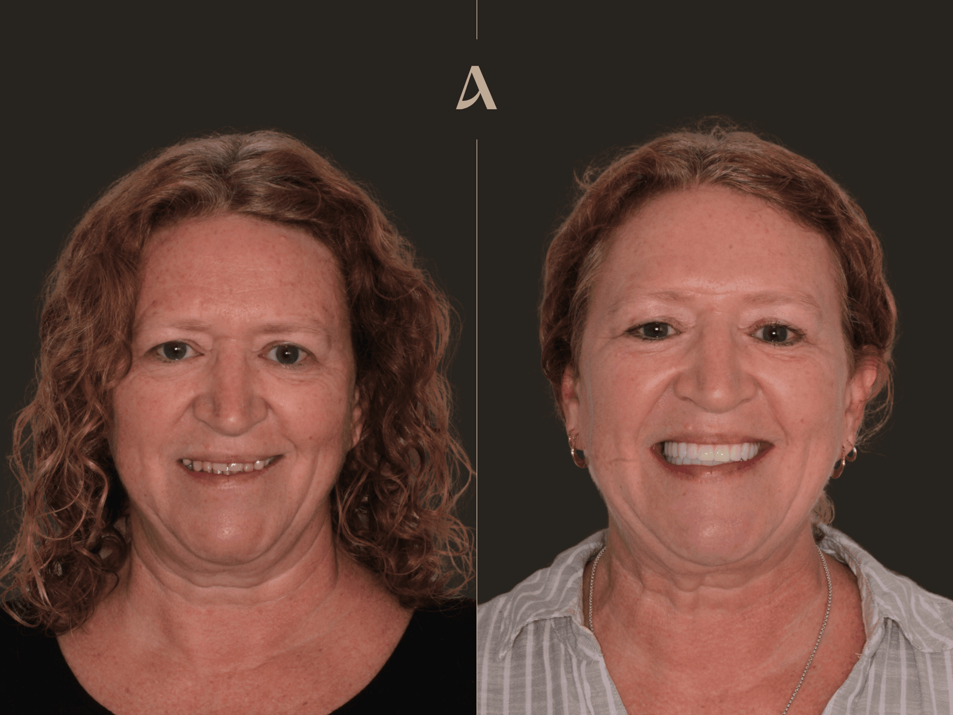 Increase Vertical Dimension, All on X – 5 months – ArtSmiles Gold Coast