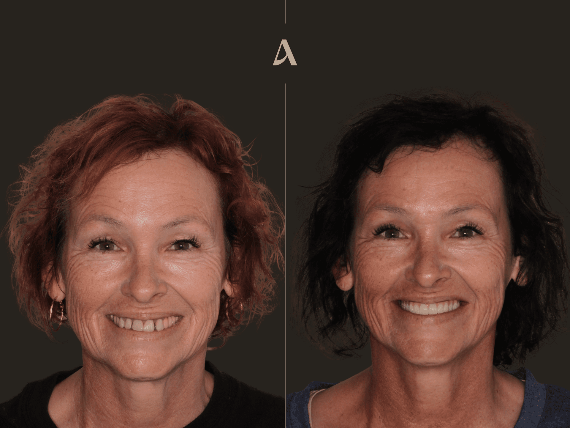 Increase Vertical Dimension, All on X – 5 months – ArtSmiles Gold Coast