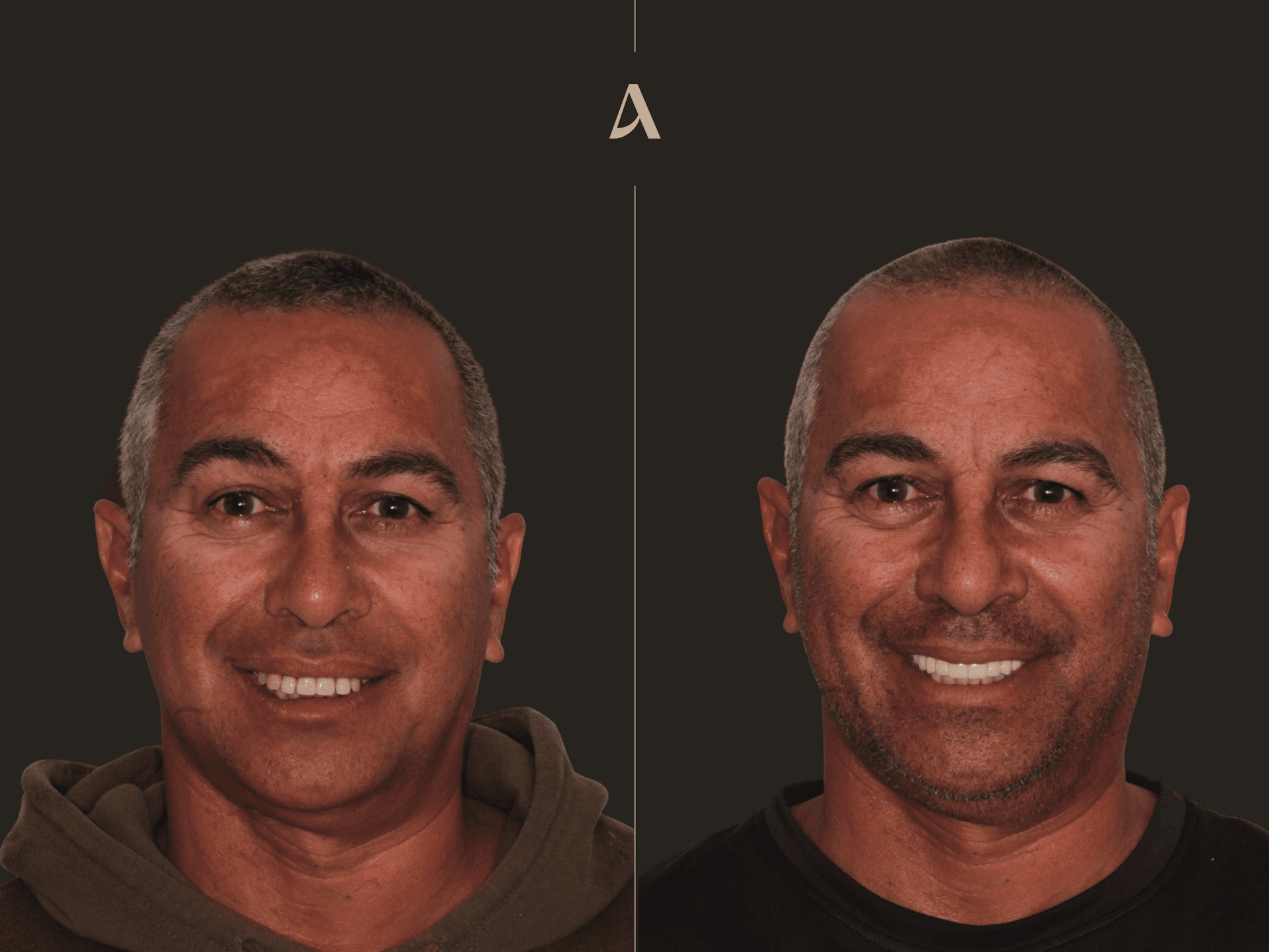 Increase Vertical Dimension, All on X – 9 months – ArtSmiles Gold Coast