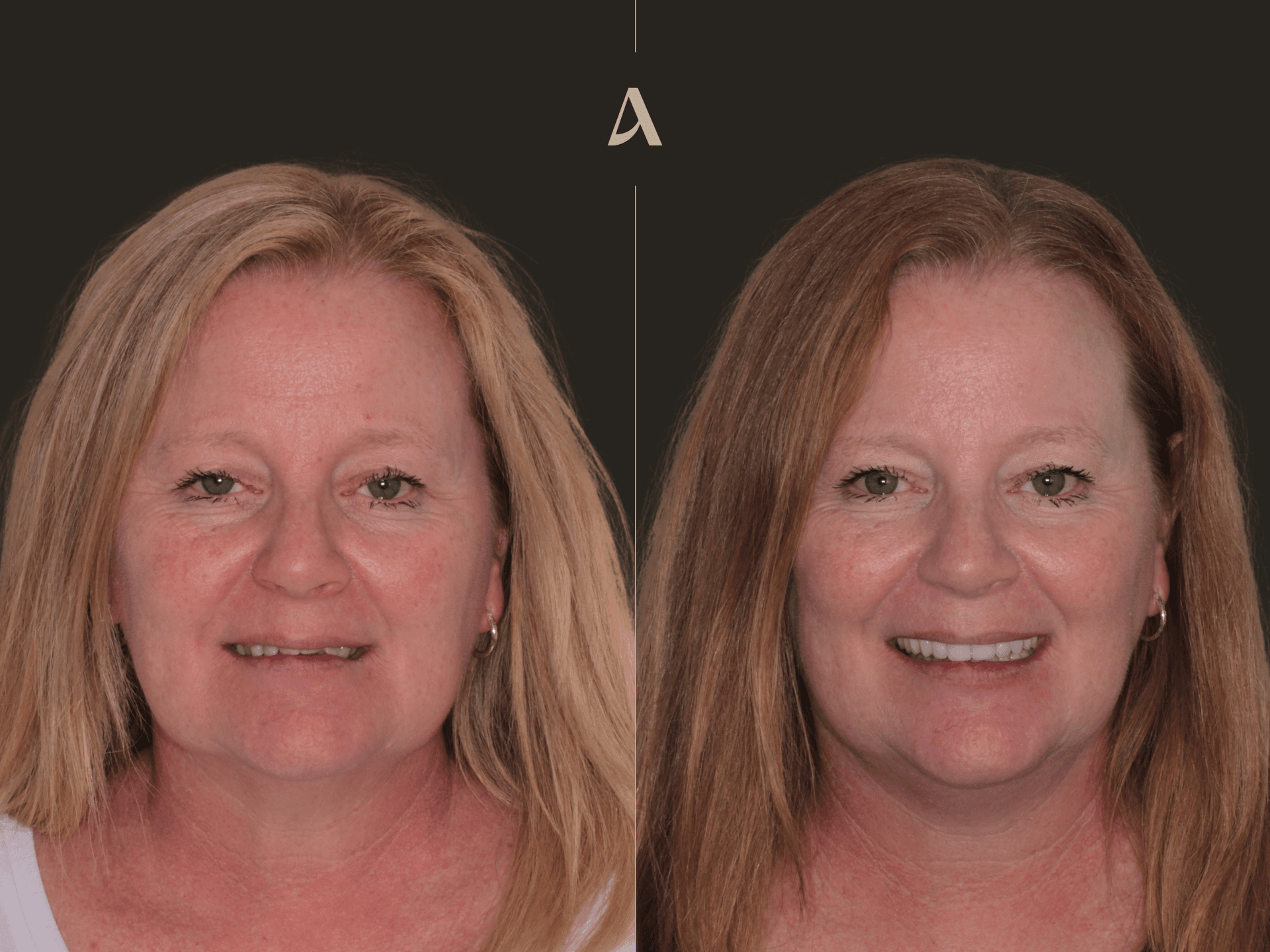 Increase Vertical Dimension, Overdenture – 4 months – ArtSmiles Gold Coast