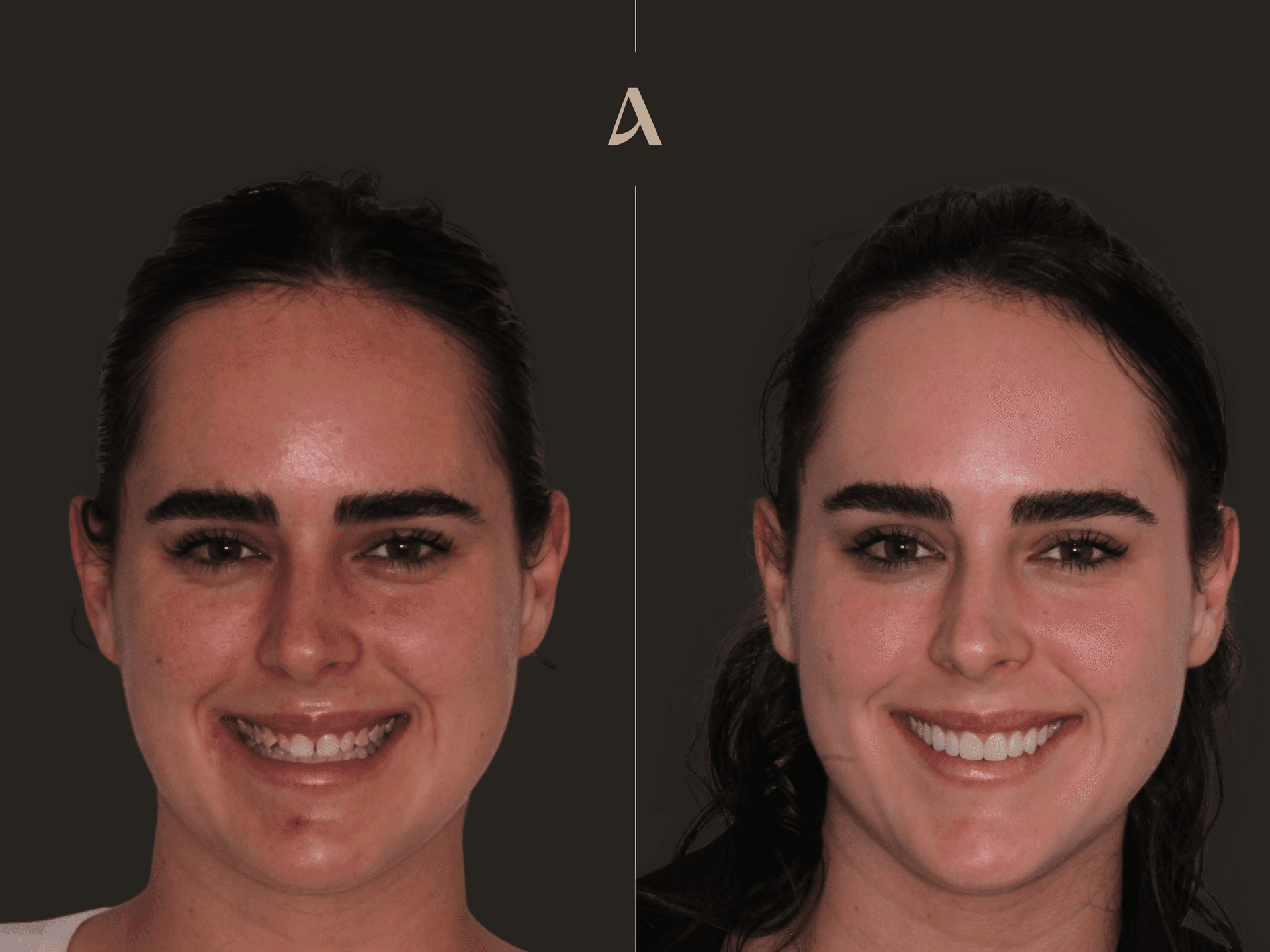 Zirconia Veneers — Before & After