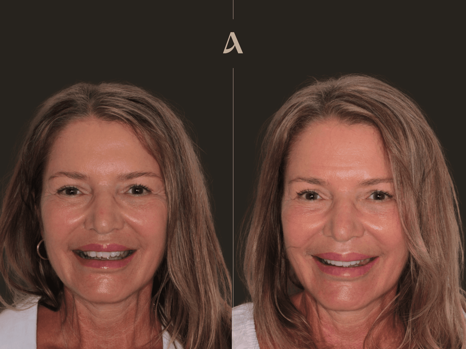 Porcelain Veneers – 1 month – ArtSmiles Gold Coast