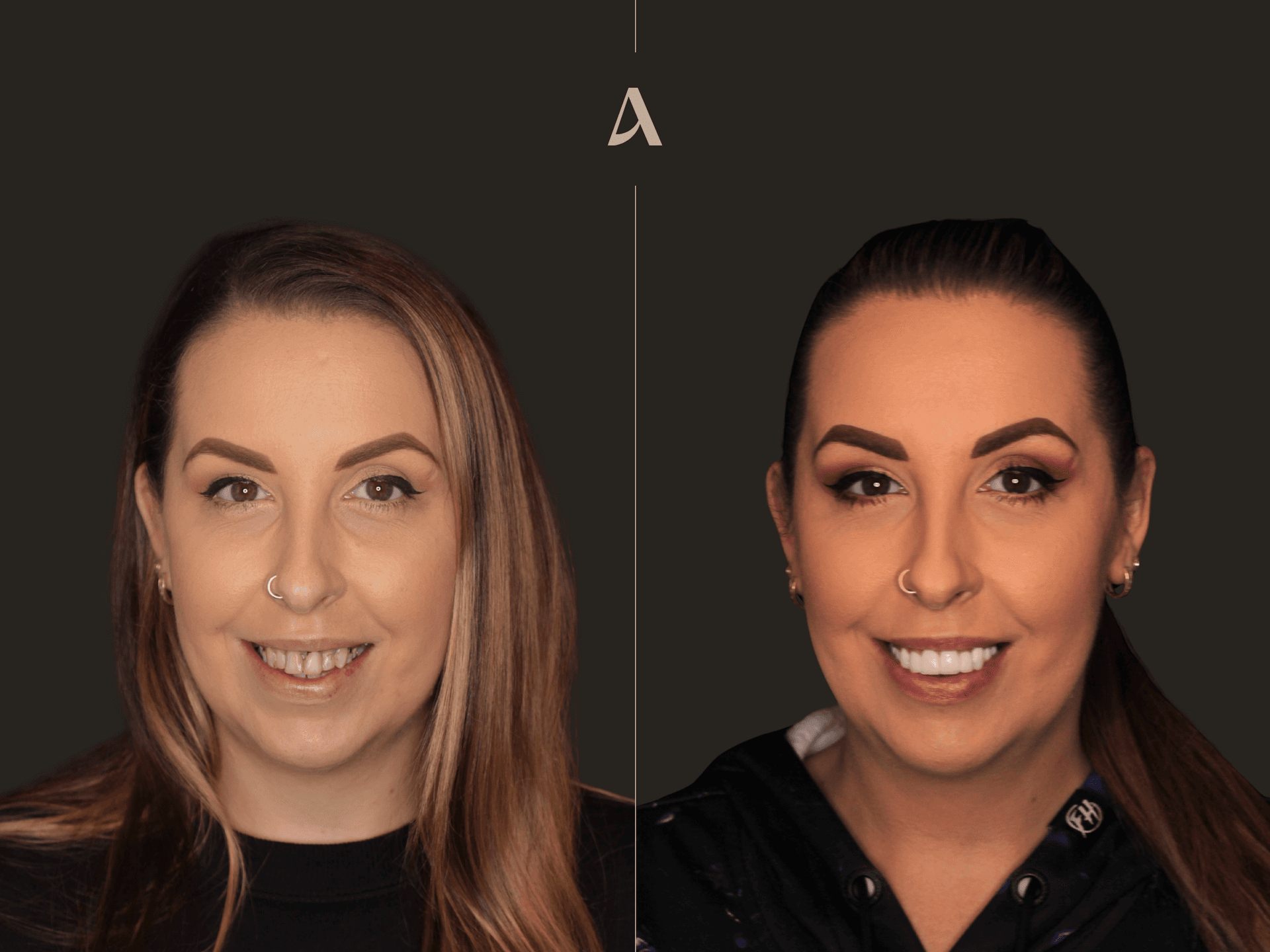 Porcelain Veneers, Crown & Bridge – 2 months – ArtSmiles Gold Coast