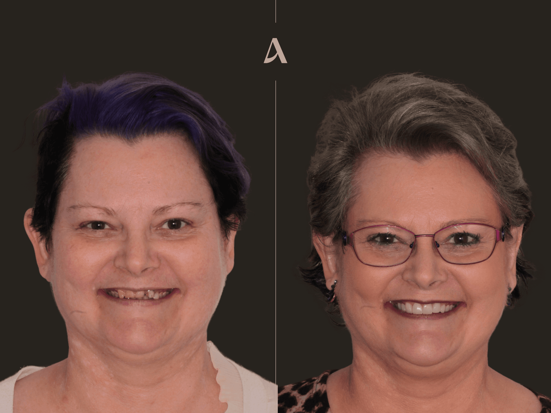Porcelain Veneers, Crown & Bridge – 3 months – ArtSmiles Gold Coast