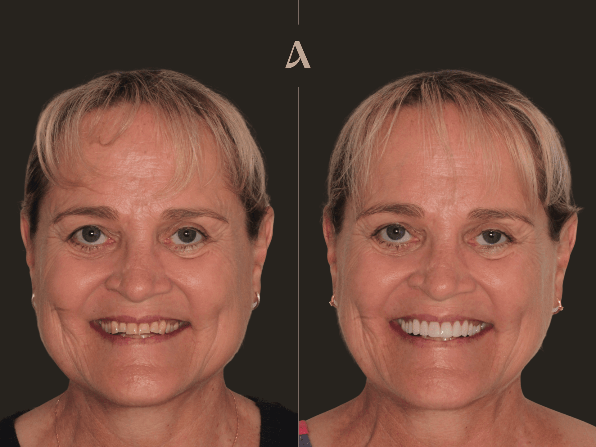 Porcelain Veneers, Increase Vertical Dimension – 2 months – ArtSmiles Gold Coast