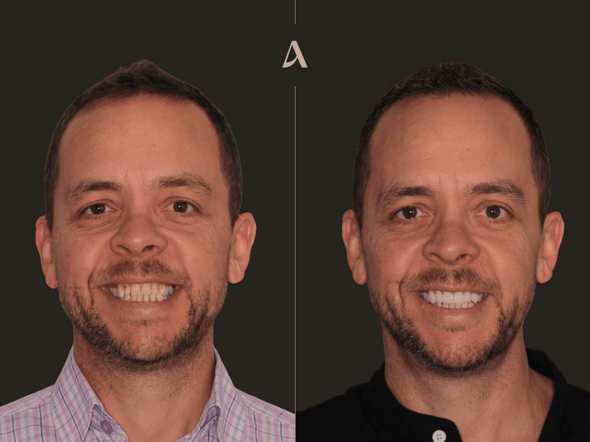 Zirconia Veneers — Before & After