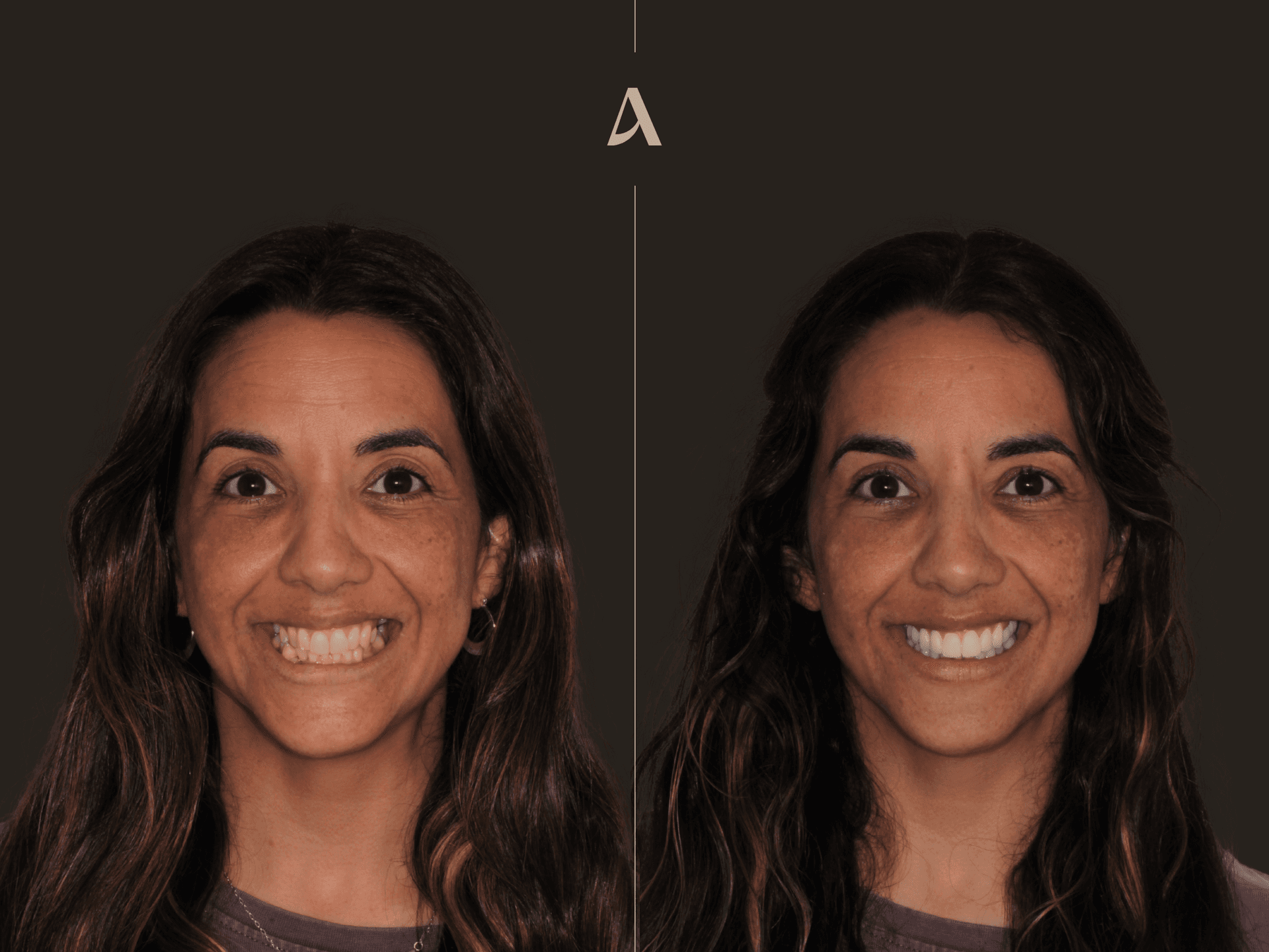 Zirconia Veneers, Crown & Bridge, Complex Rehabilitation – 1 month – ArtSmiles Gold Coast