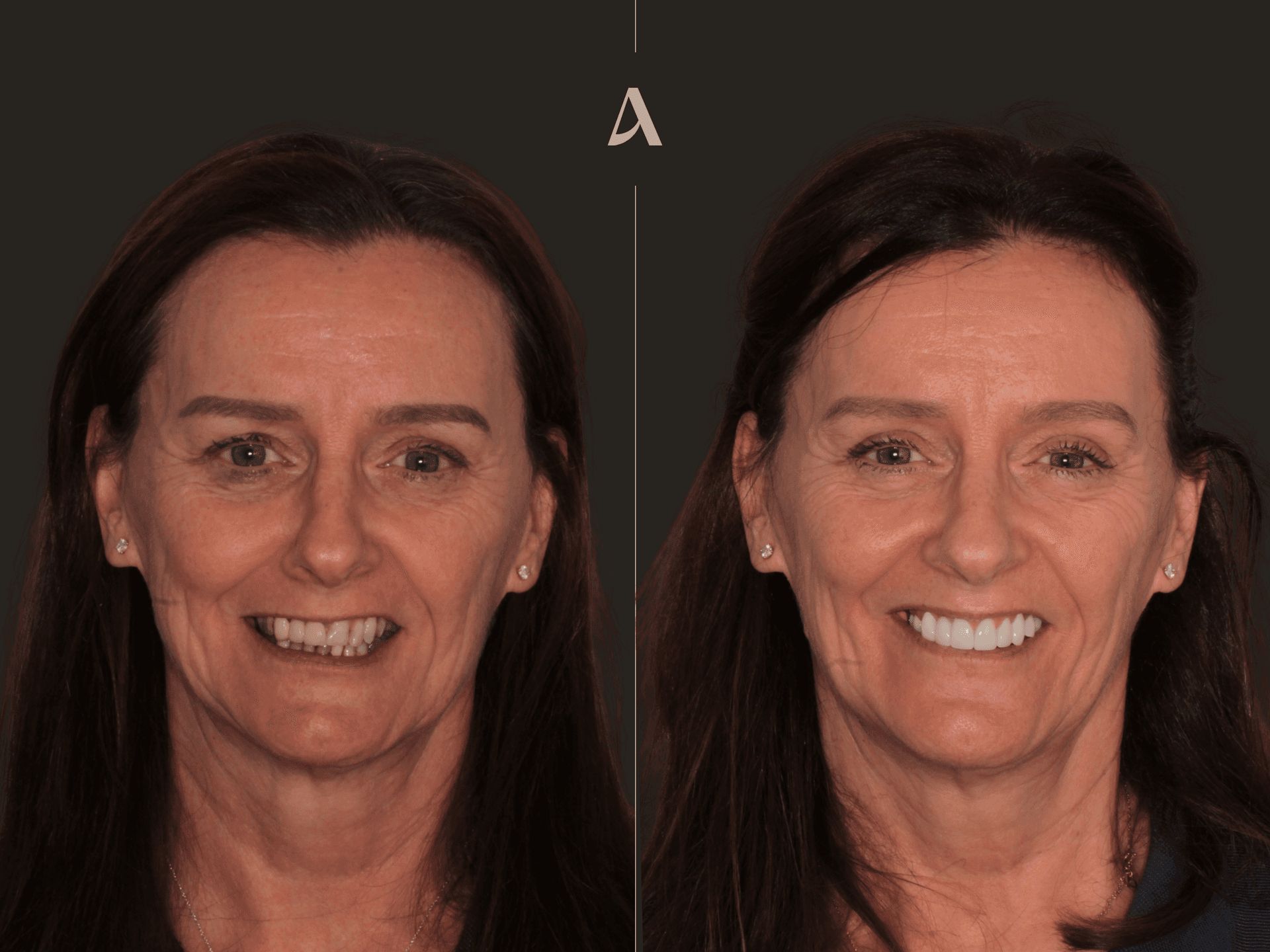Zirconia Veneers, Crown & Bridge, Complex Rehabilitation, All on X – 6 months – ArtSmiles Gold Coast