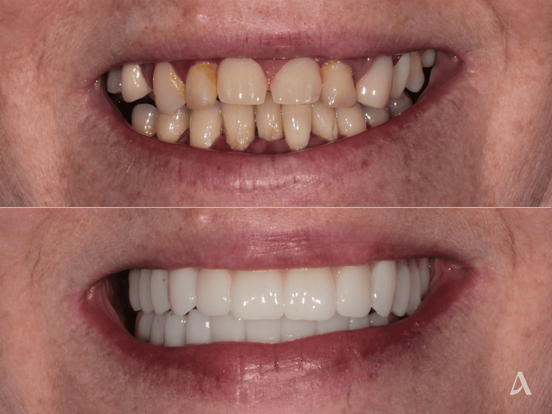 All on X – 5 months – ArtSmiles Gold Coast