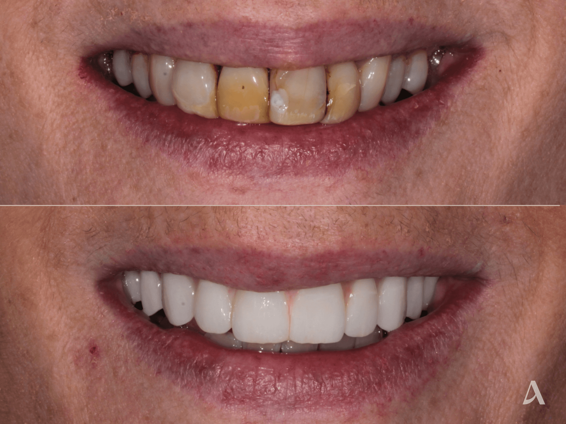 All on X – 6 months – ArtSmiles Gold Coast