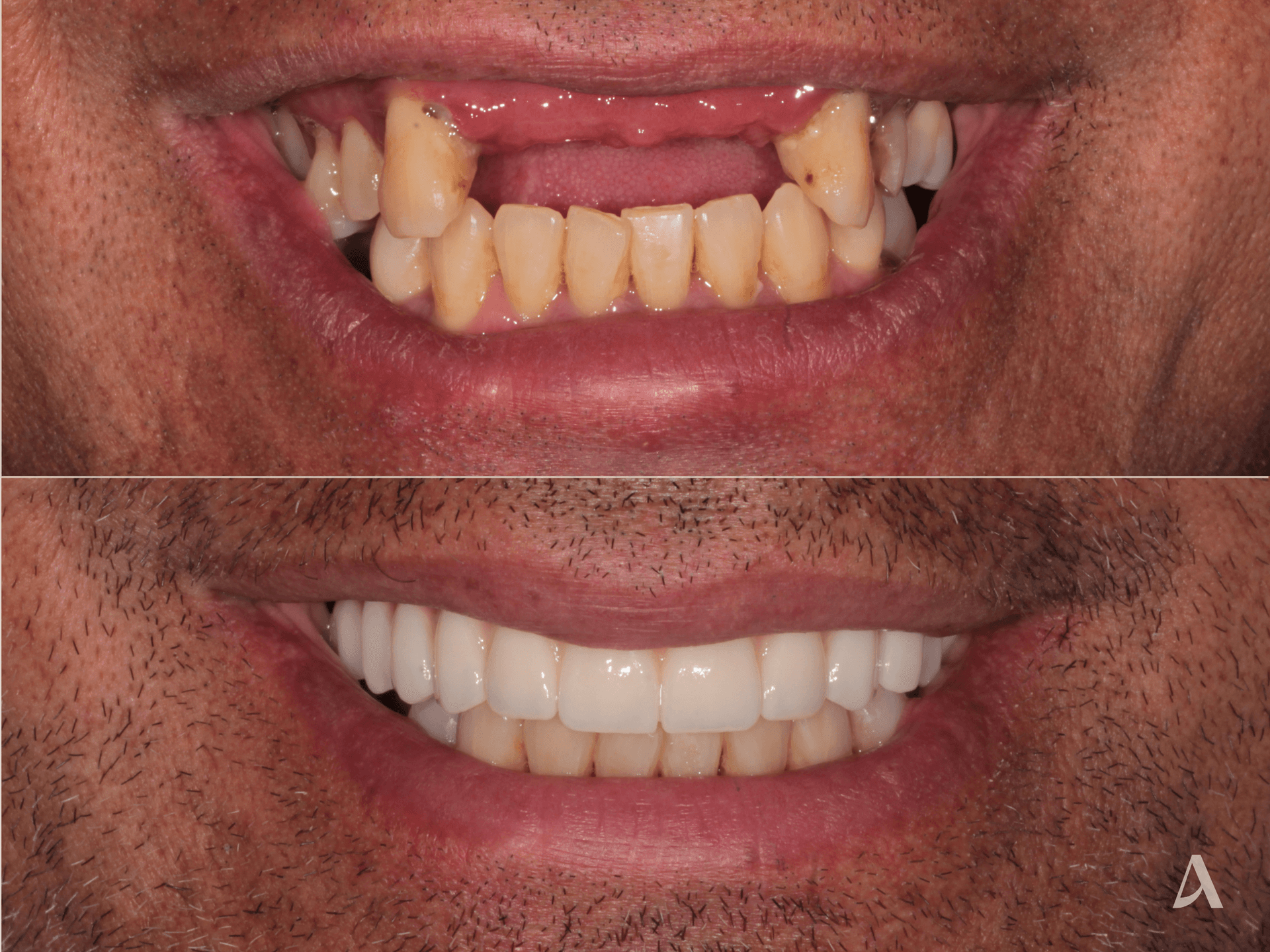 All on X – 9 months – ArtSmiles Gold Coast