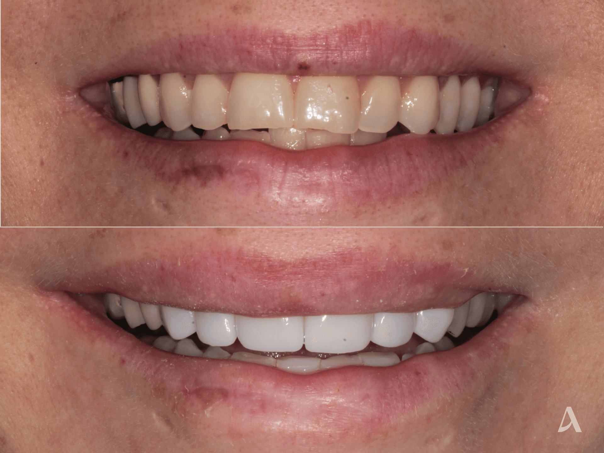 Porcelain Veneers – 1 month – ArtSmiles Gold Coast