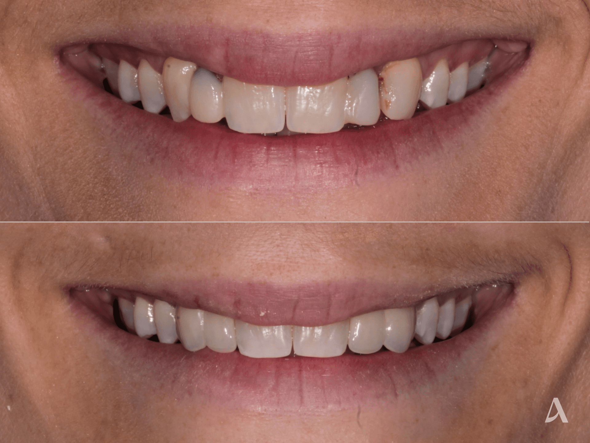 Crown & Bridge – 1 month – ArtSmiles Gold Coast