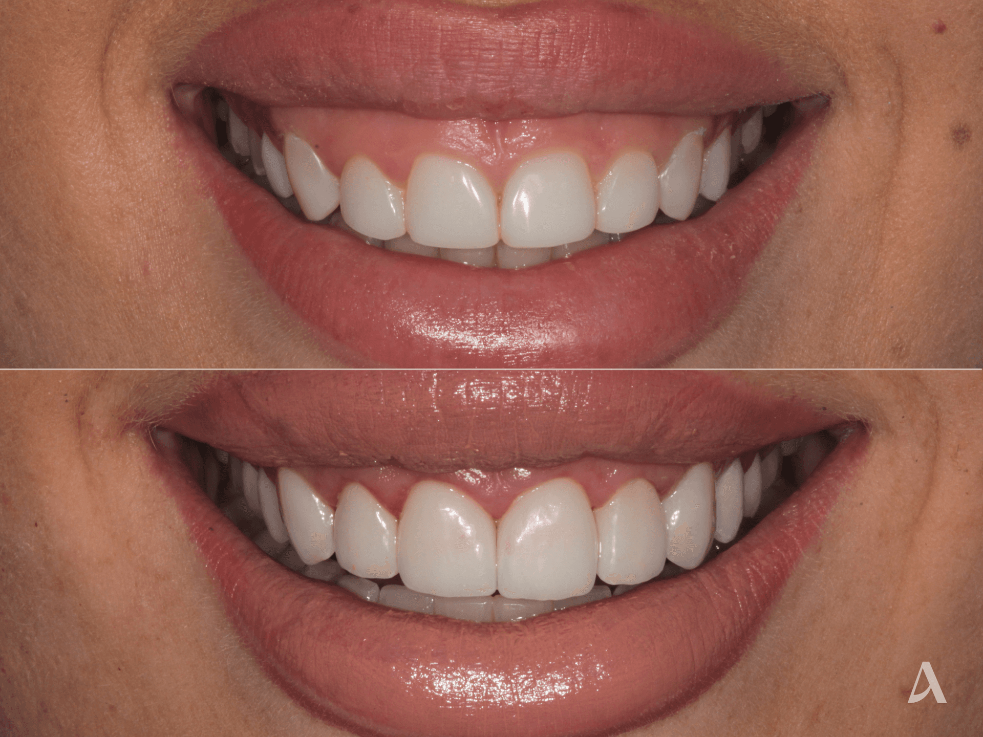 Gum Recontouring, Porcelain Veneers – 3 months – ArtSmiles Gold Coast