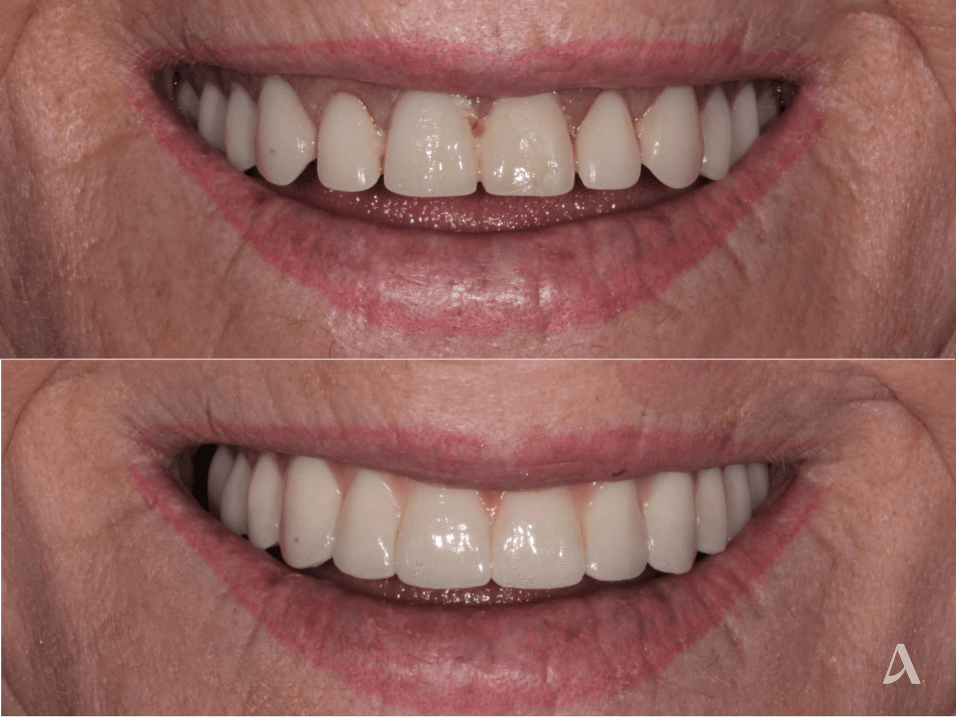 All on X – 3 months – ArtSmiles Gold Coast