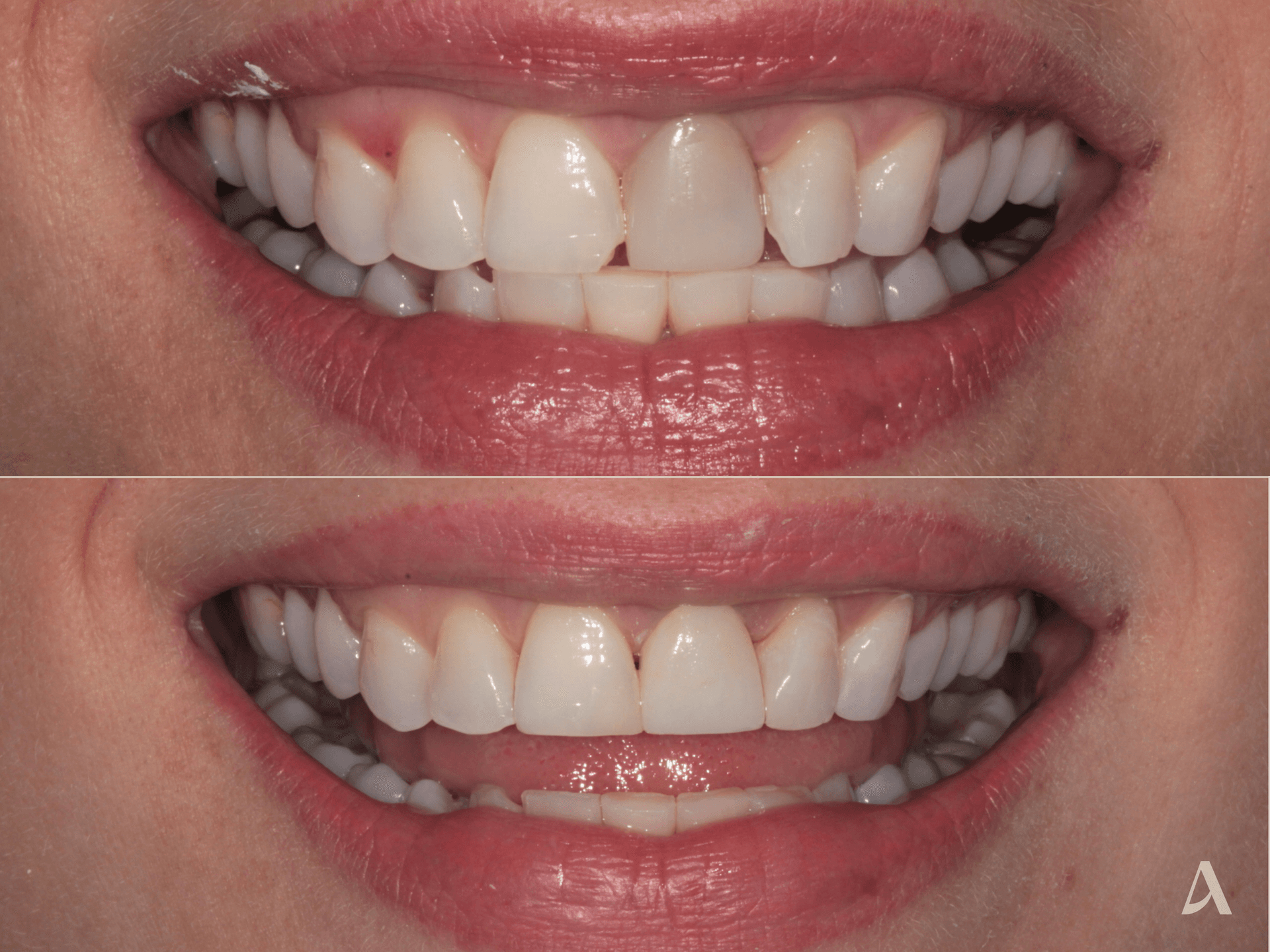 Composite Veneers – 1 month – ArtSmiles Gold Coast