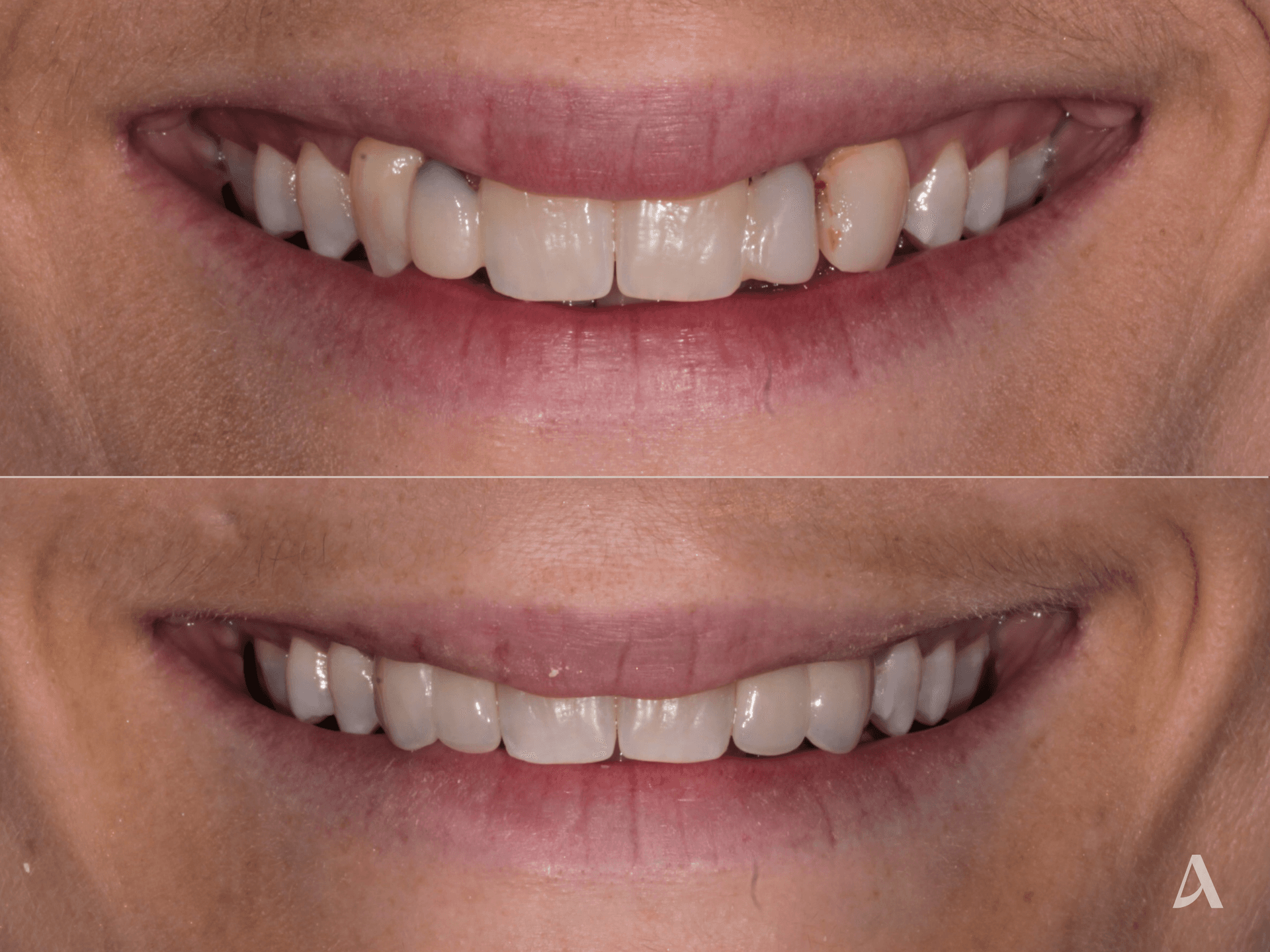 Crown & Bridge – 1 month – ArtSmiles Gold Coast