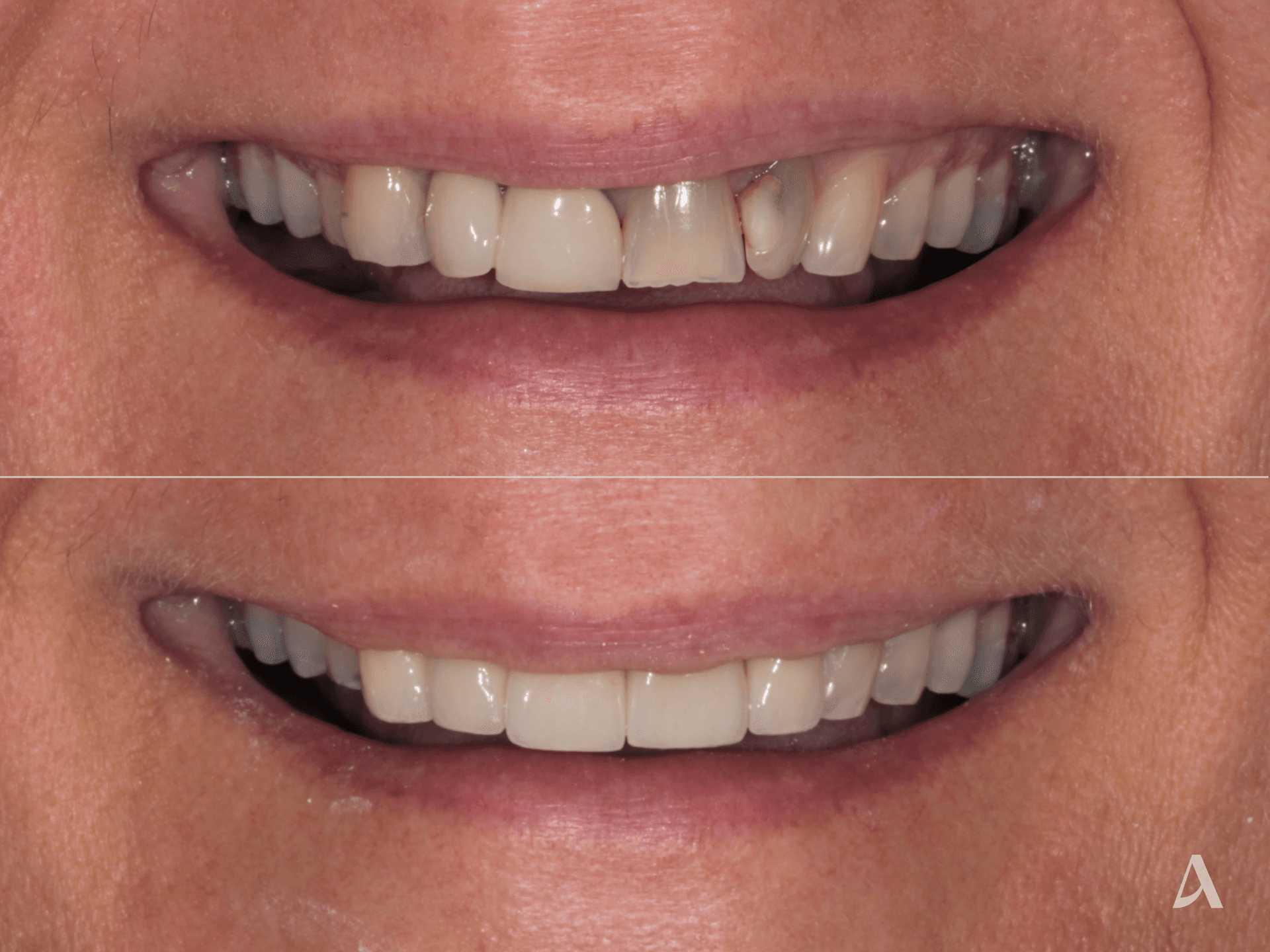 Crown & Bridge – 1 month – ArtSmiles Gold Coast