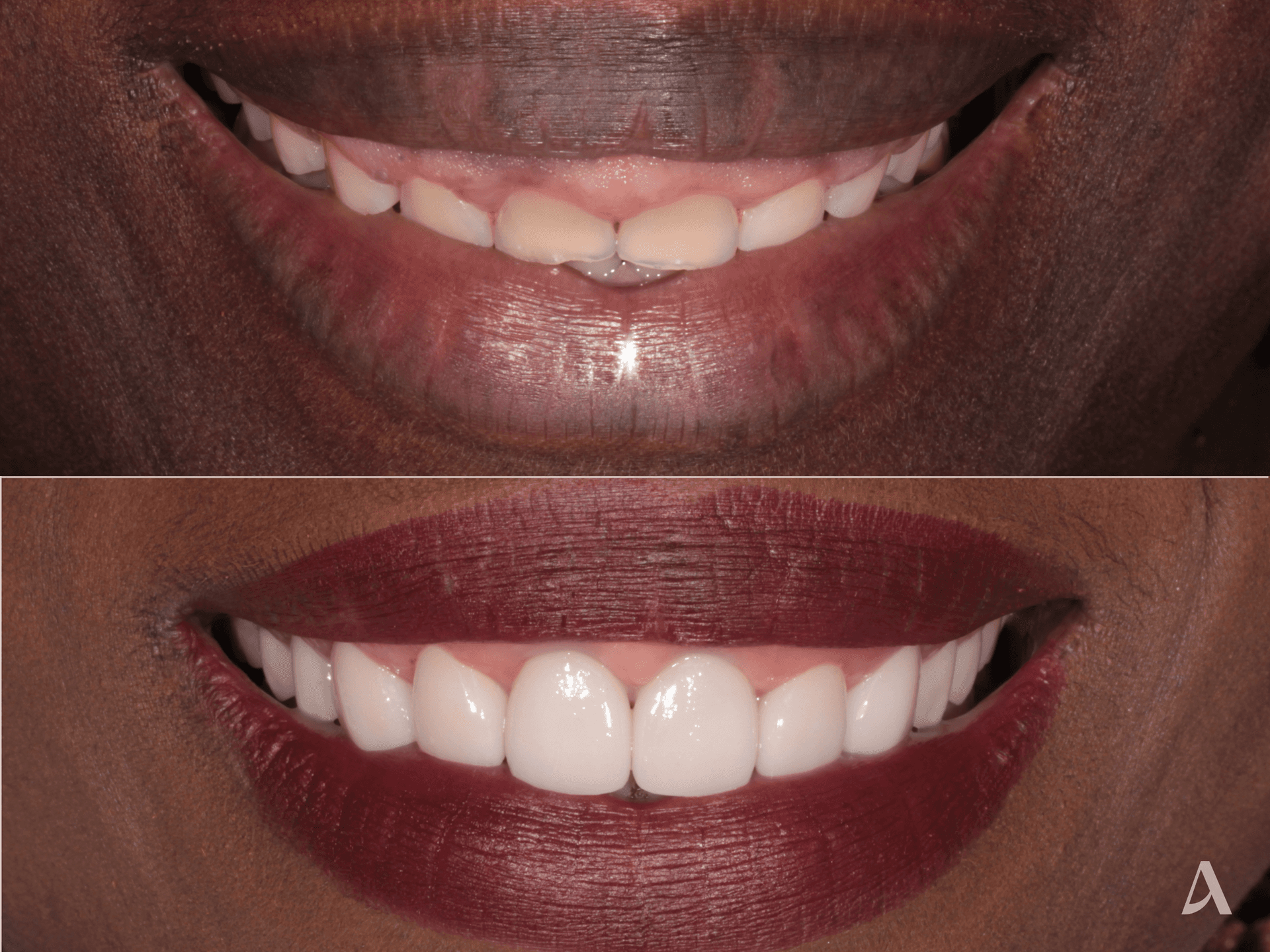 Gum Recontouring, Porcelain Veneers – 3 months – ArtSmiles Gold Coast