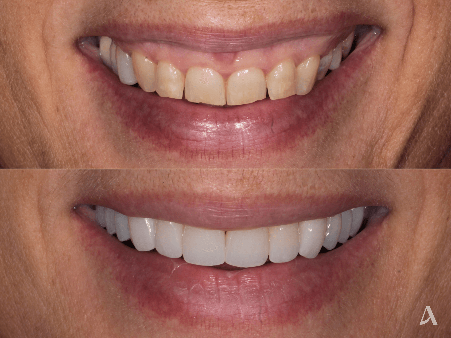 Gum Recontouring, Zirconia Veneers – 3 months – ArtSmiles Gold Coast