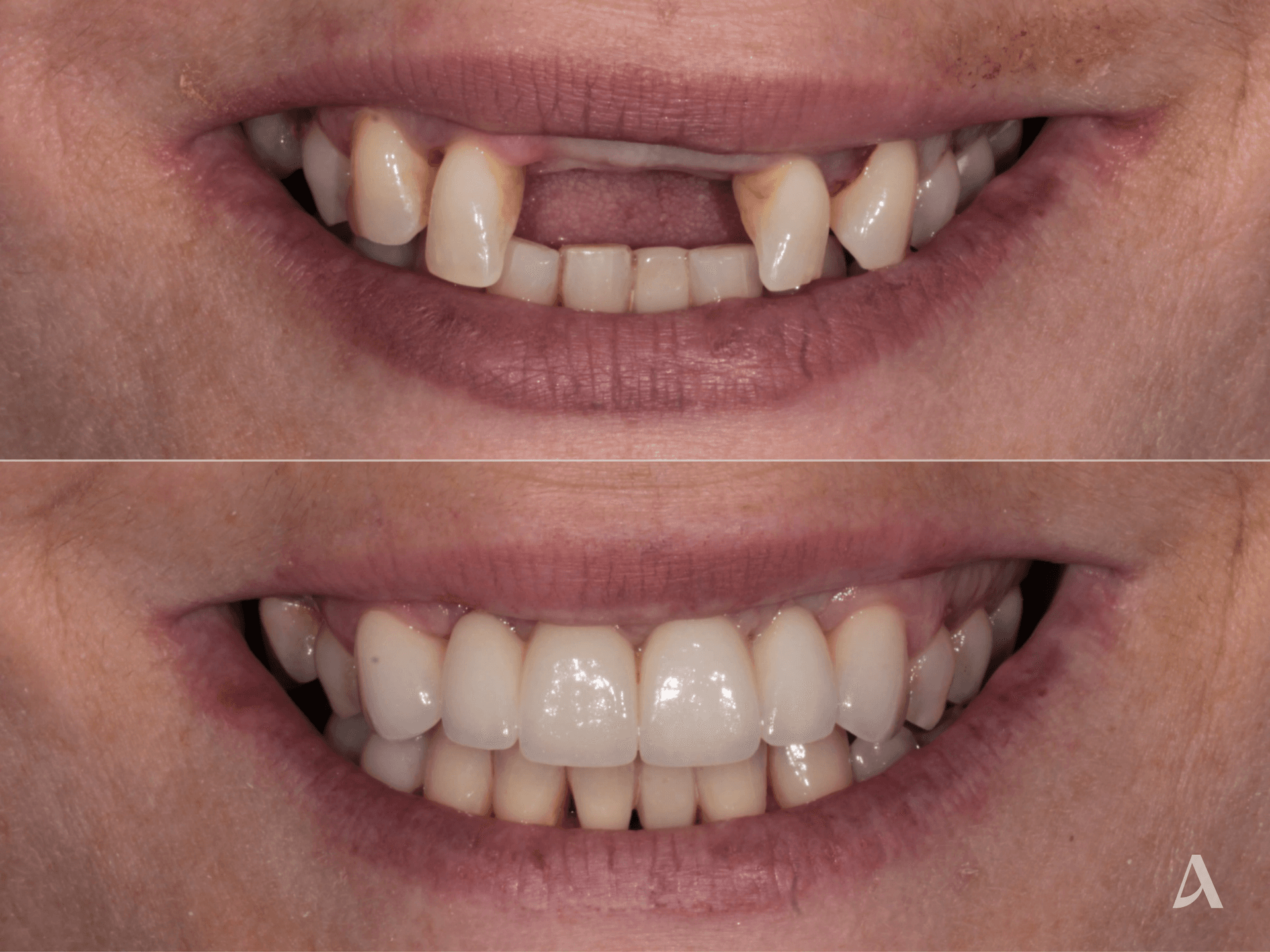 Implant, Crown & Bridge – 4 months – ArtSmiles Gold Coast