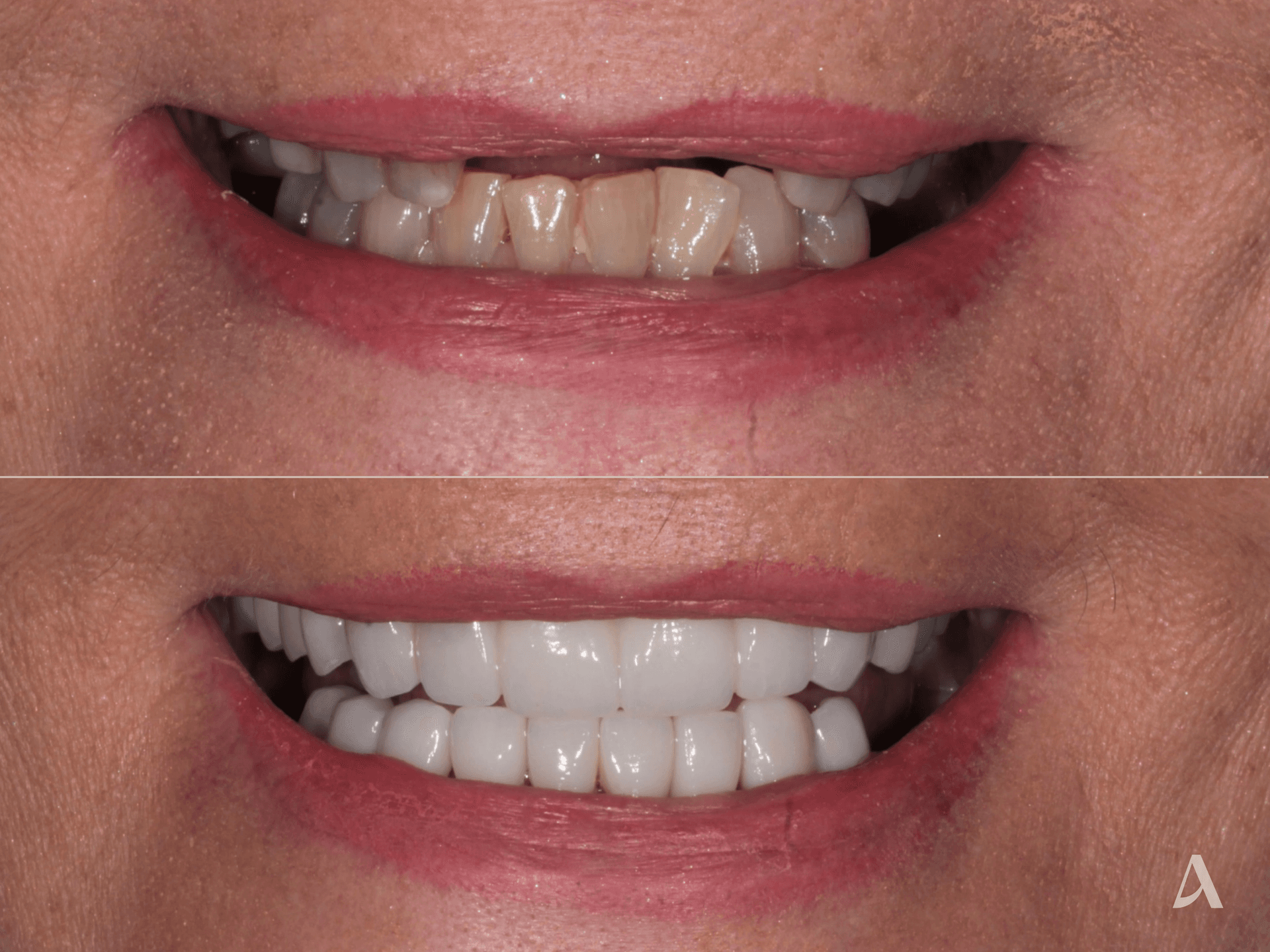 Implant, Crown & Bridge, Complex Rehabilitation – 2 months – ArtSmiles Gold Coast