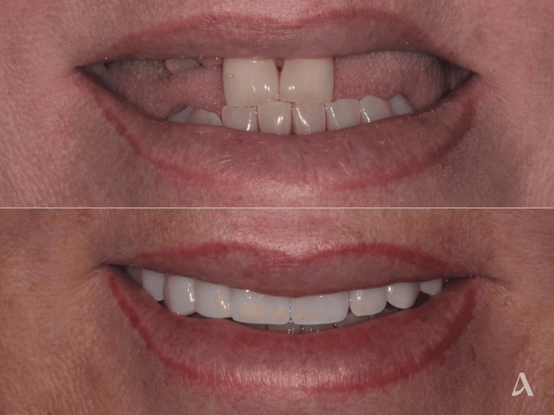 Implant, Crown & Bridge, Complex Rehabilitation – 7 months – ArtSmiles Gold Coast