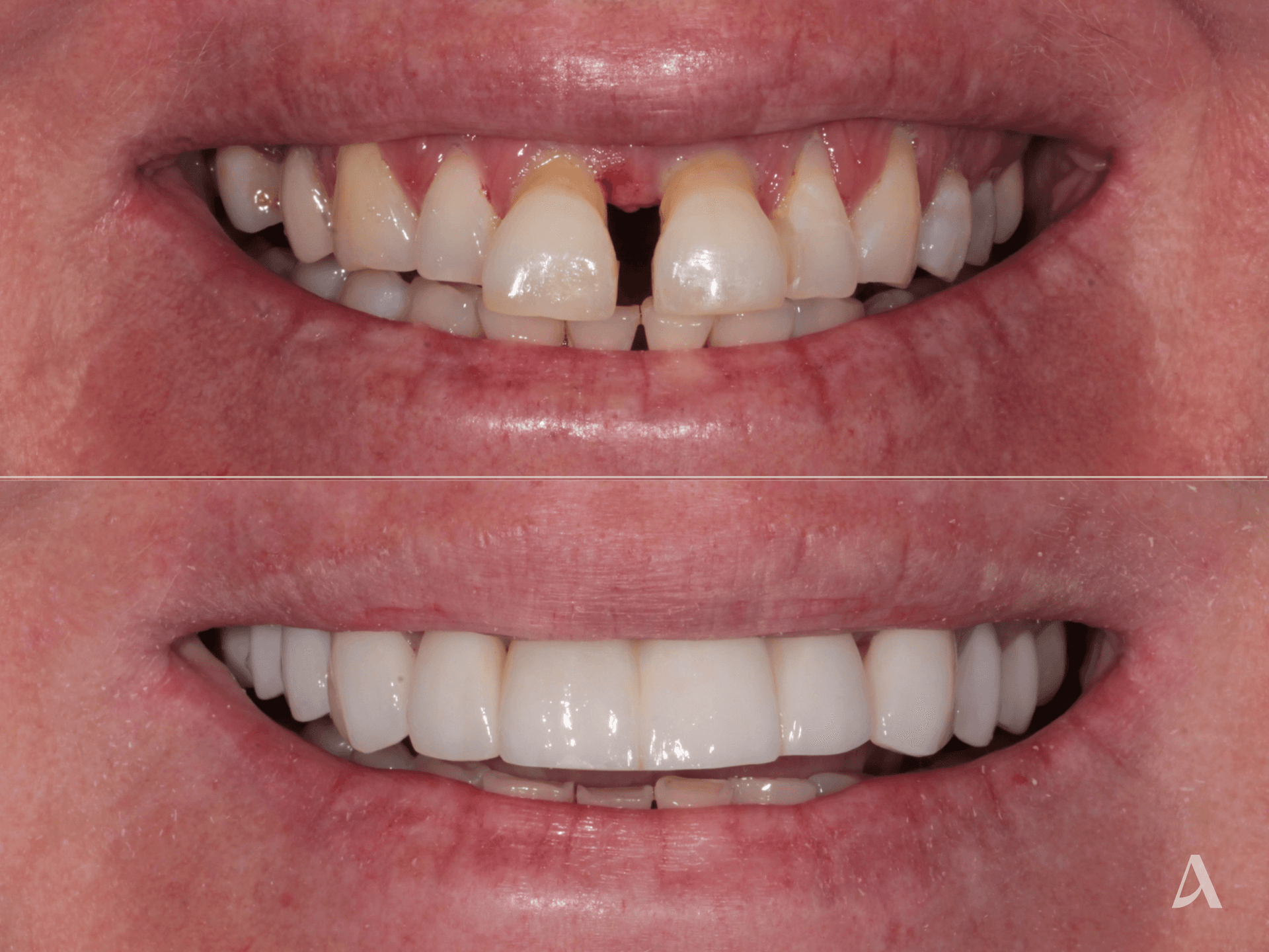 Implant, Crown & Bridge, Gum Disease – 6 months – ArtSmiles Gold Coast
