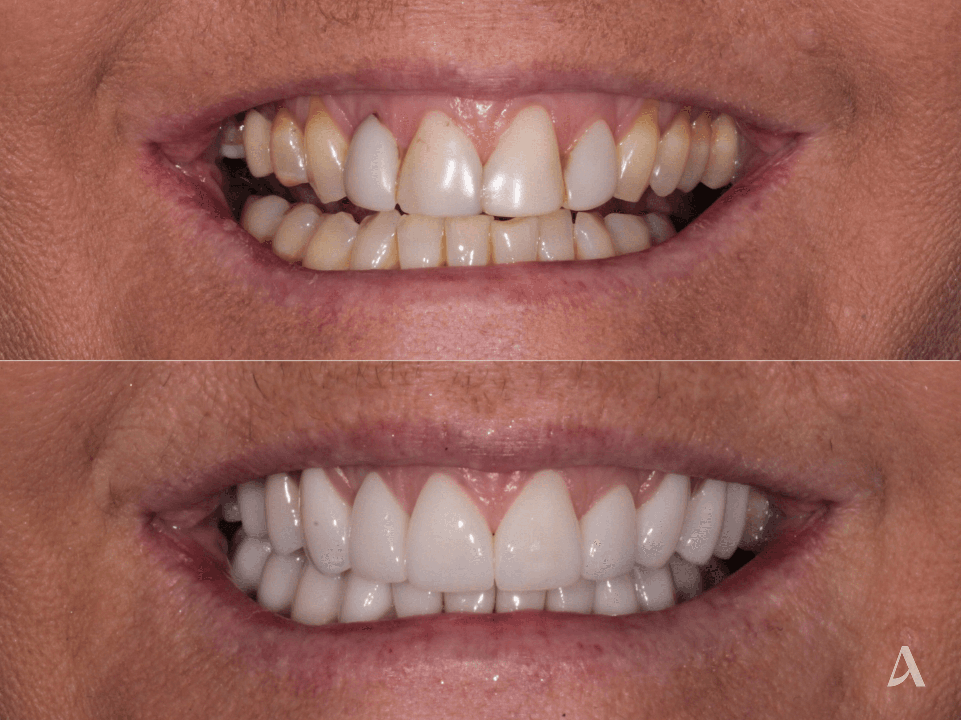 Implant, Porcelain Veneers, Complex Rehabilitation – 4 months – ArtSmiles Gold Coast