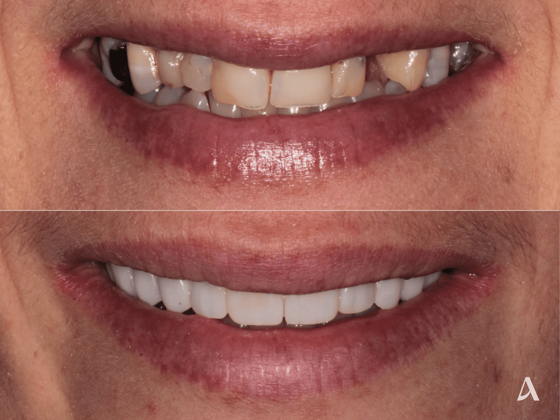 Implant, Porcelain Veneers, Crown & Bridge, Complex Rehabilitation – 10 months – ArtSmiles Gold Coast