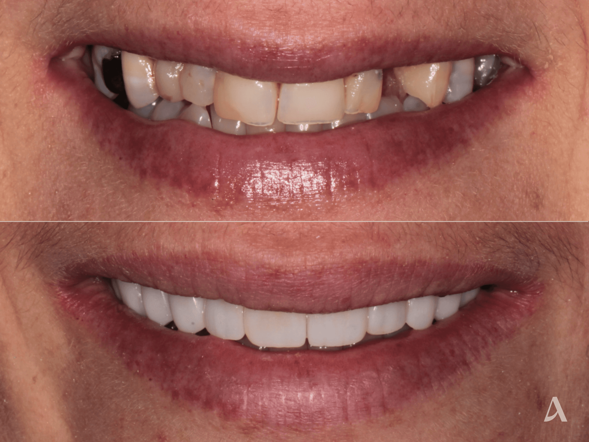 Implant, Porcelain Veneers, Crown & Bridge, Complex Rehabilitation – 11 months – ArtSmiles Gold Coast