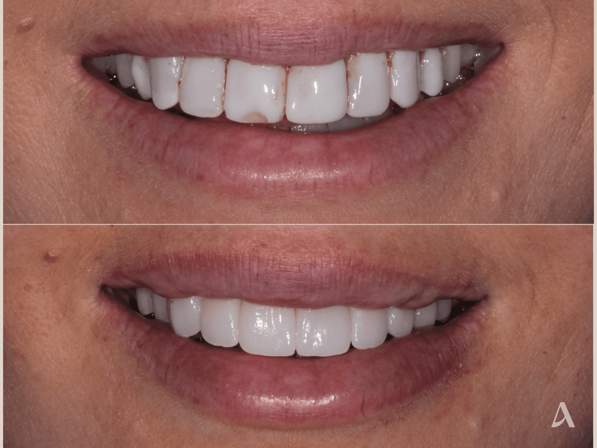 Implant, Zirconia Veneers – 3 months – ArtSmiles Gold Coast