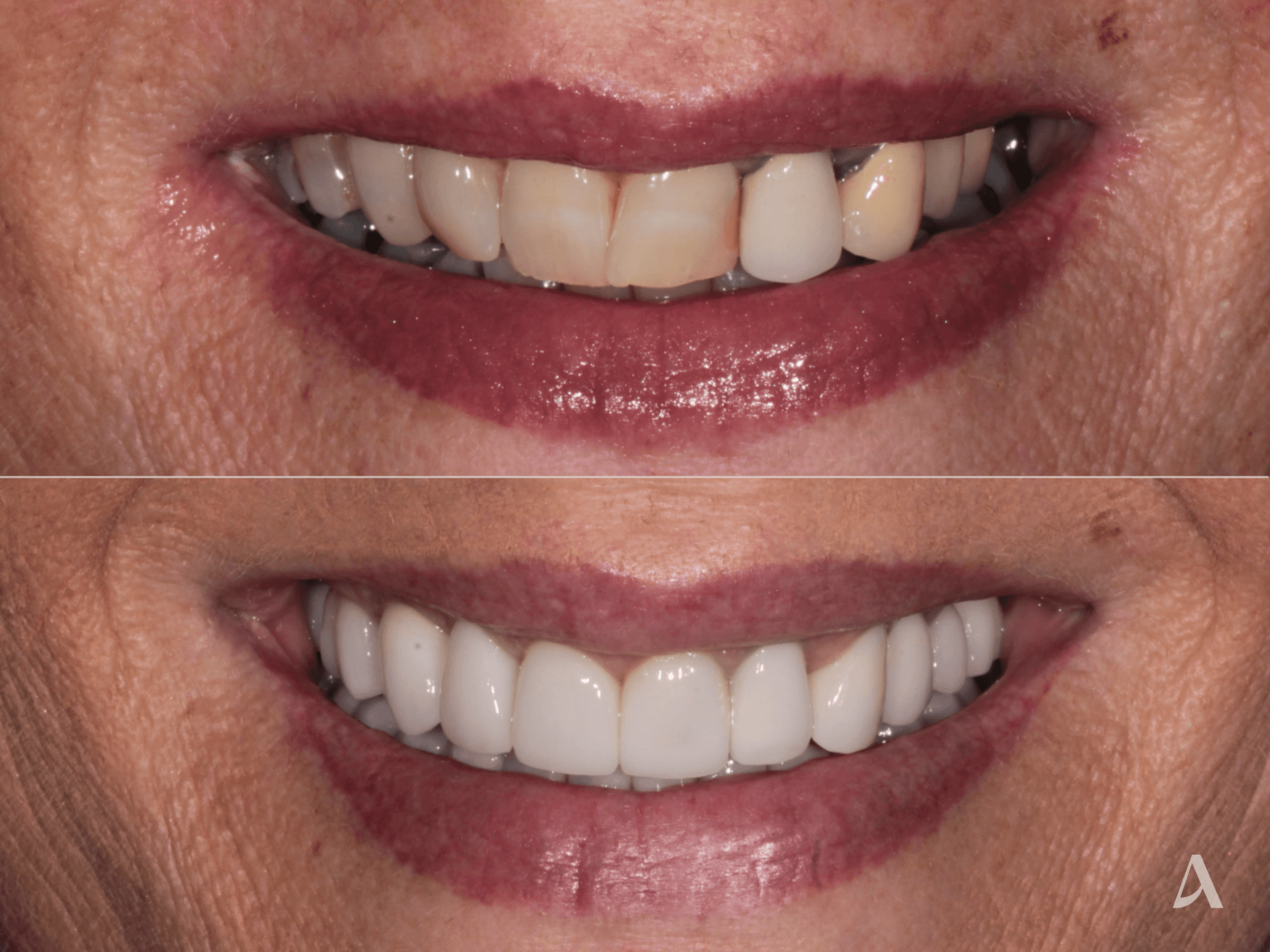 Implant, Zirconia Veneers, Complex Rehabilitation, Crown & Bridge – 8 months – ArtSmiles Gold Coast