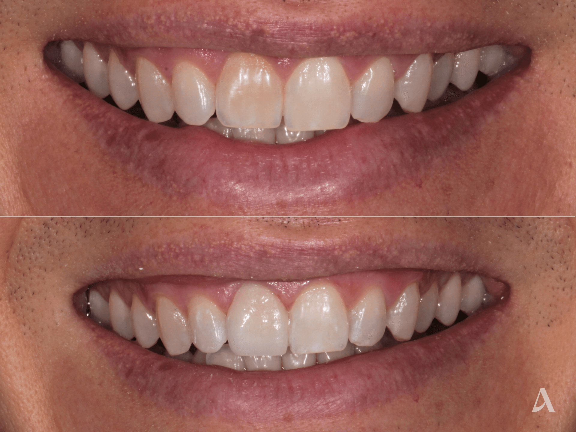 Porcelain Veneers – 1 month – ArtSmiles Gold Coast
