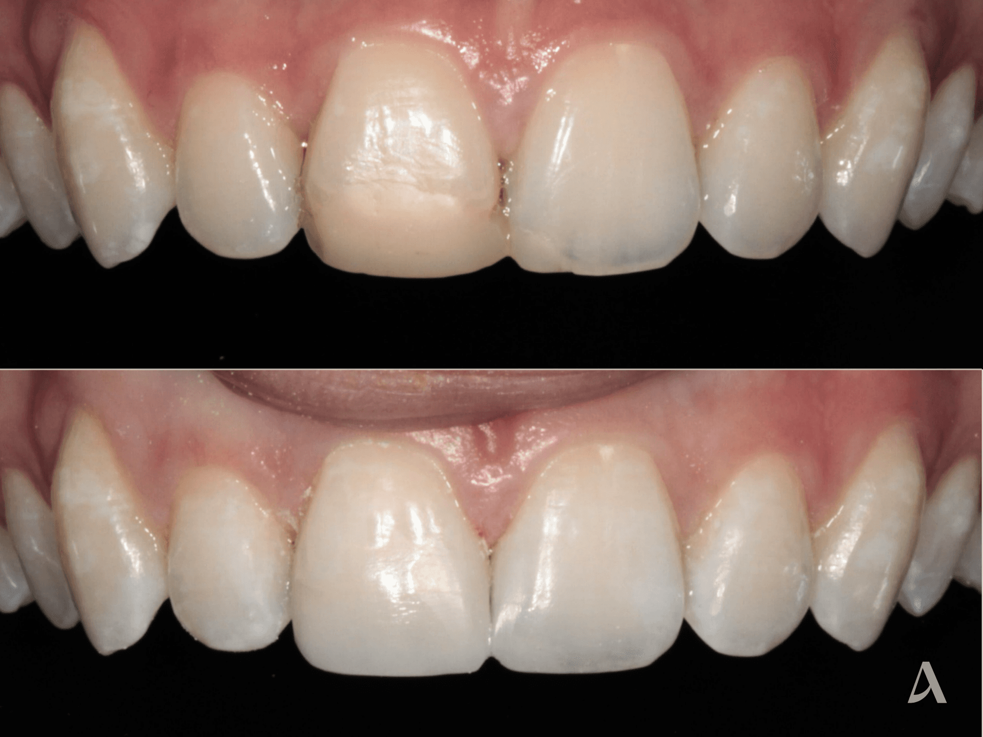 Porcelain Veneers – 1 month – ArtSmiles Gold Coast