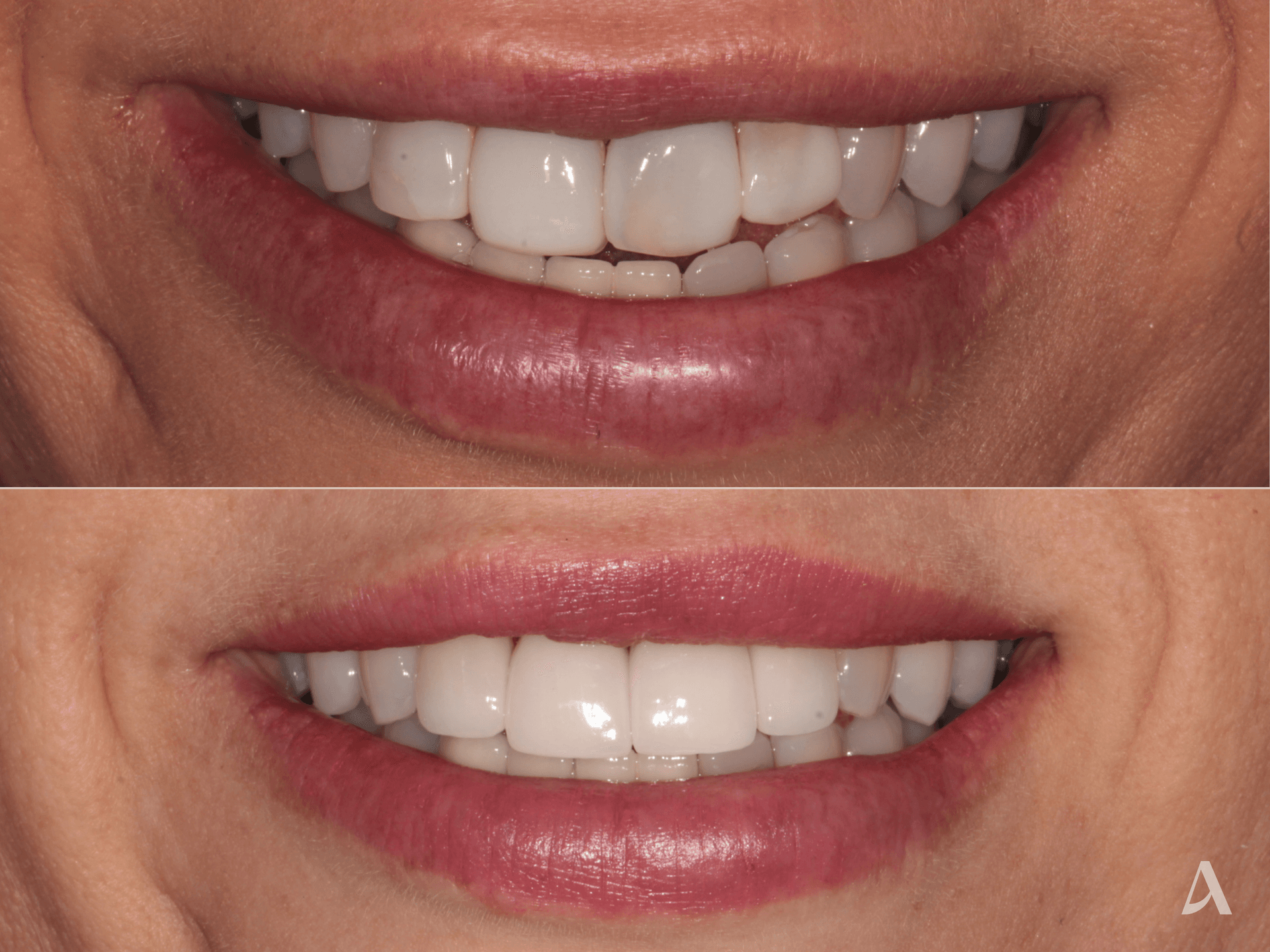 Porcelain Veneers – 1 month – ArtSmiles Gold Coast