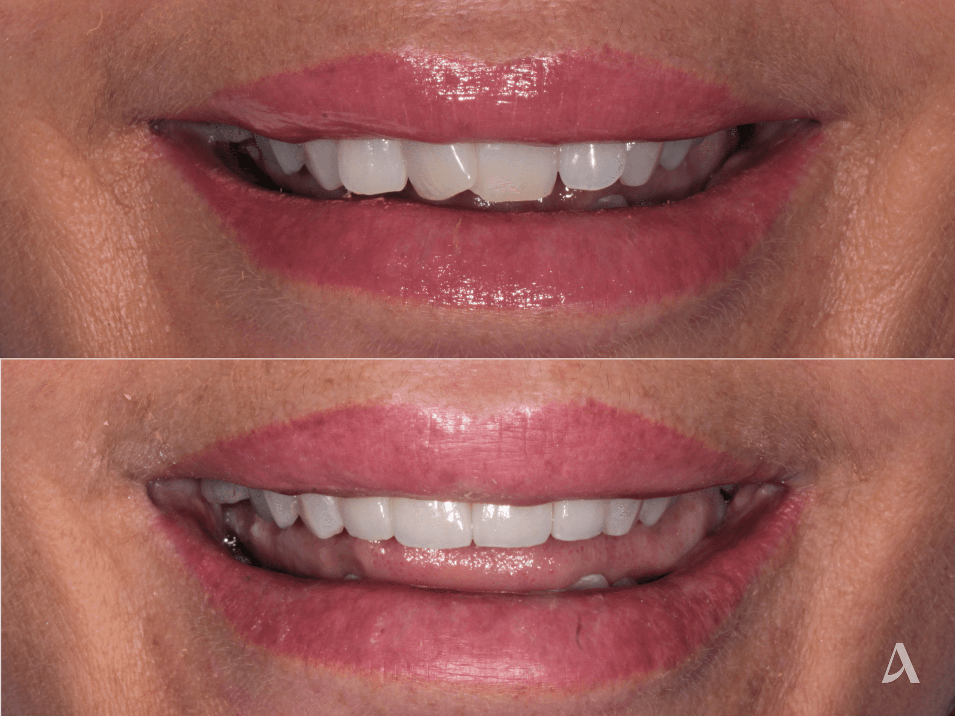 Porcelain Veneers – 1 month – ArtSmiles Gold Coast