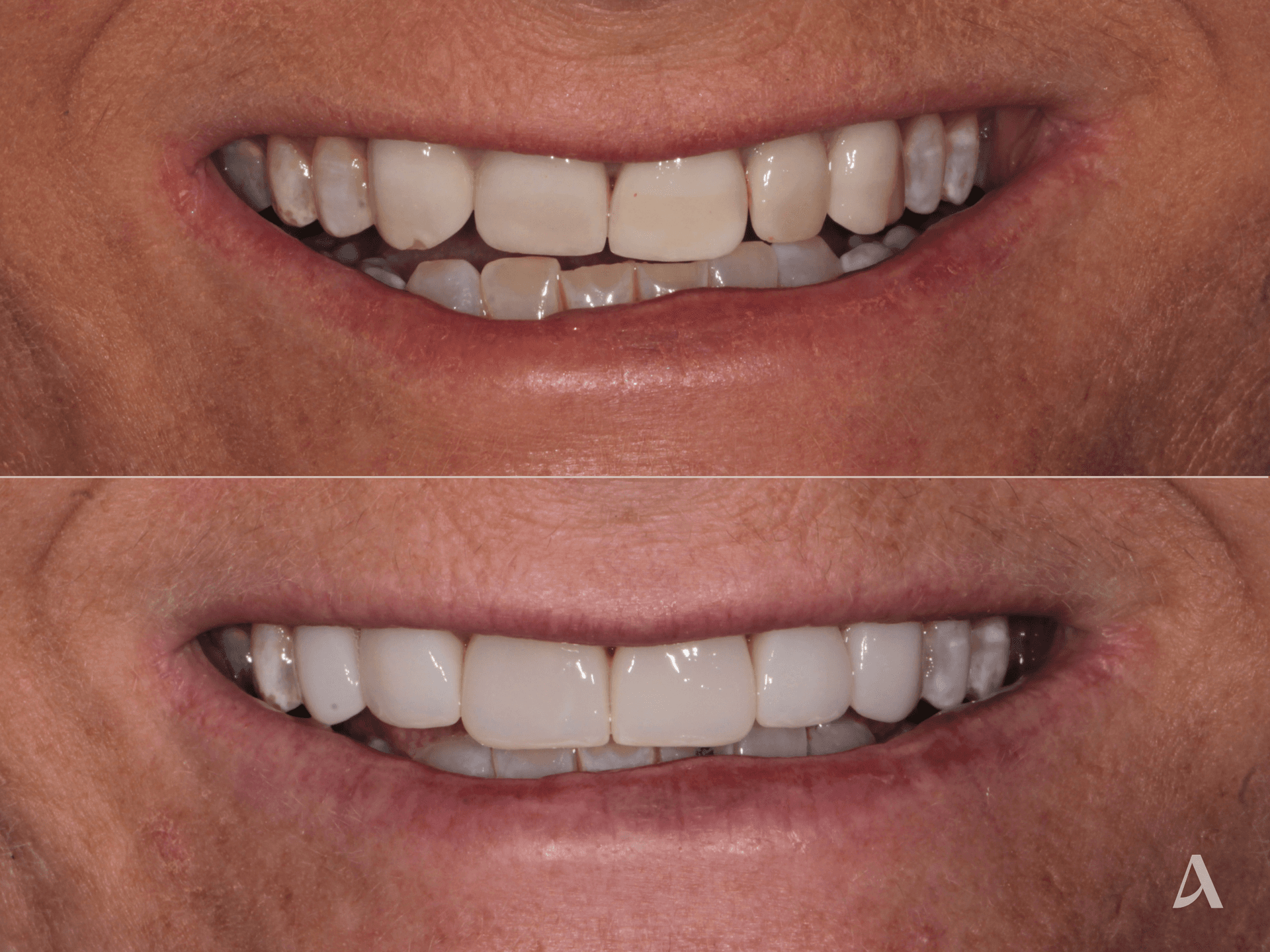 Porcelain Veneers – 1 month – ArtSmiles Gold Coast