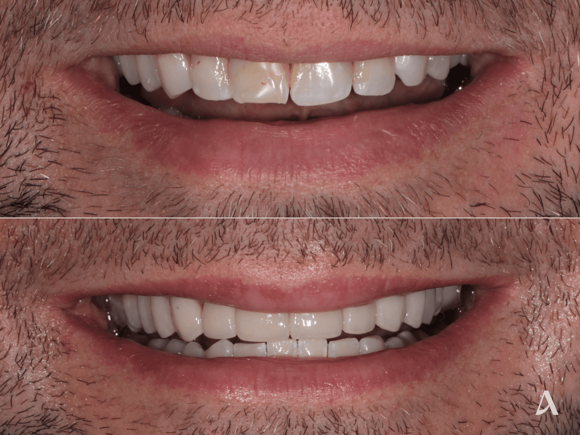 Porcelain Veneers – 1 month – ArtSmiles Gold Coast
